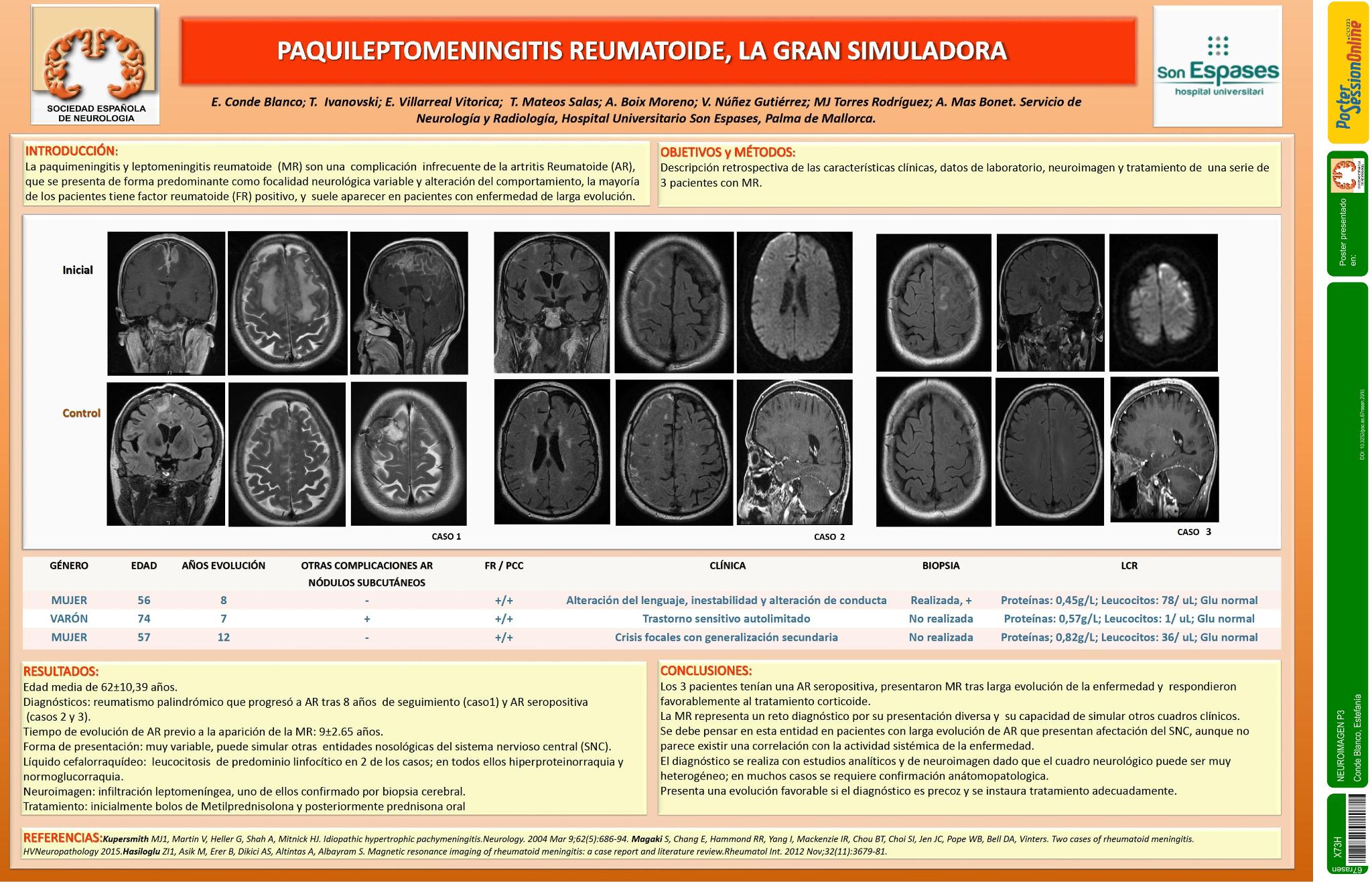 Paquileptomeningitis reumatoide, la gran simuladora