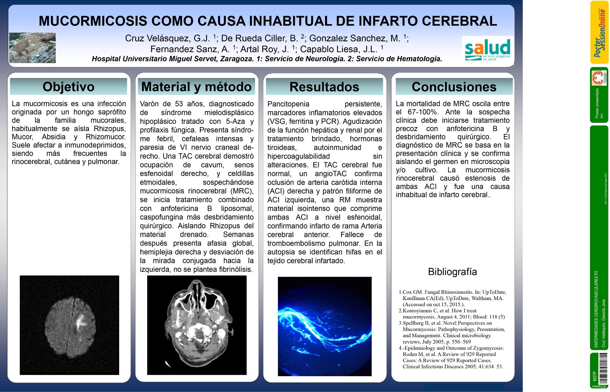 Mucormicosis como causa inhabitual de infarto cerebral