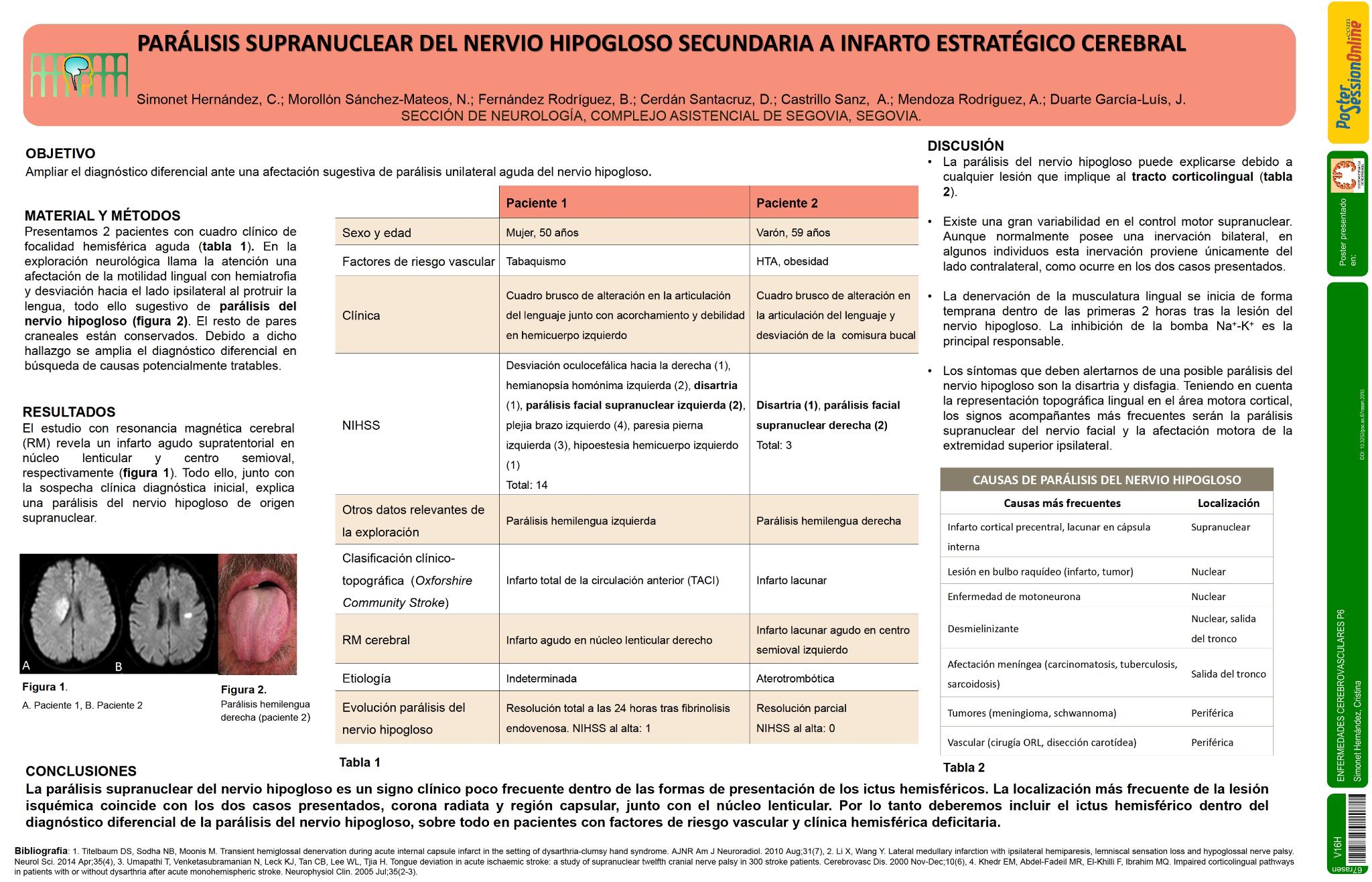 Parálisis supranuclear del nervio hipogloso secundaria a infarto estratégico lacunar