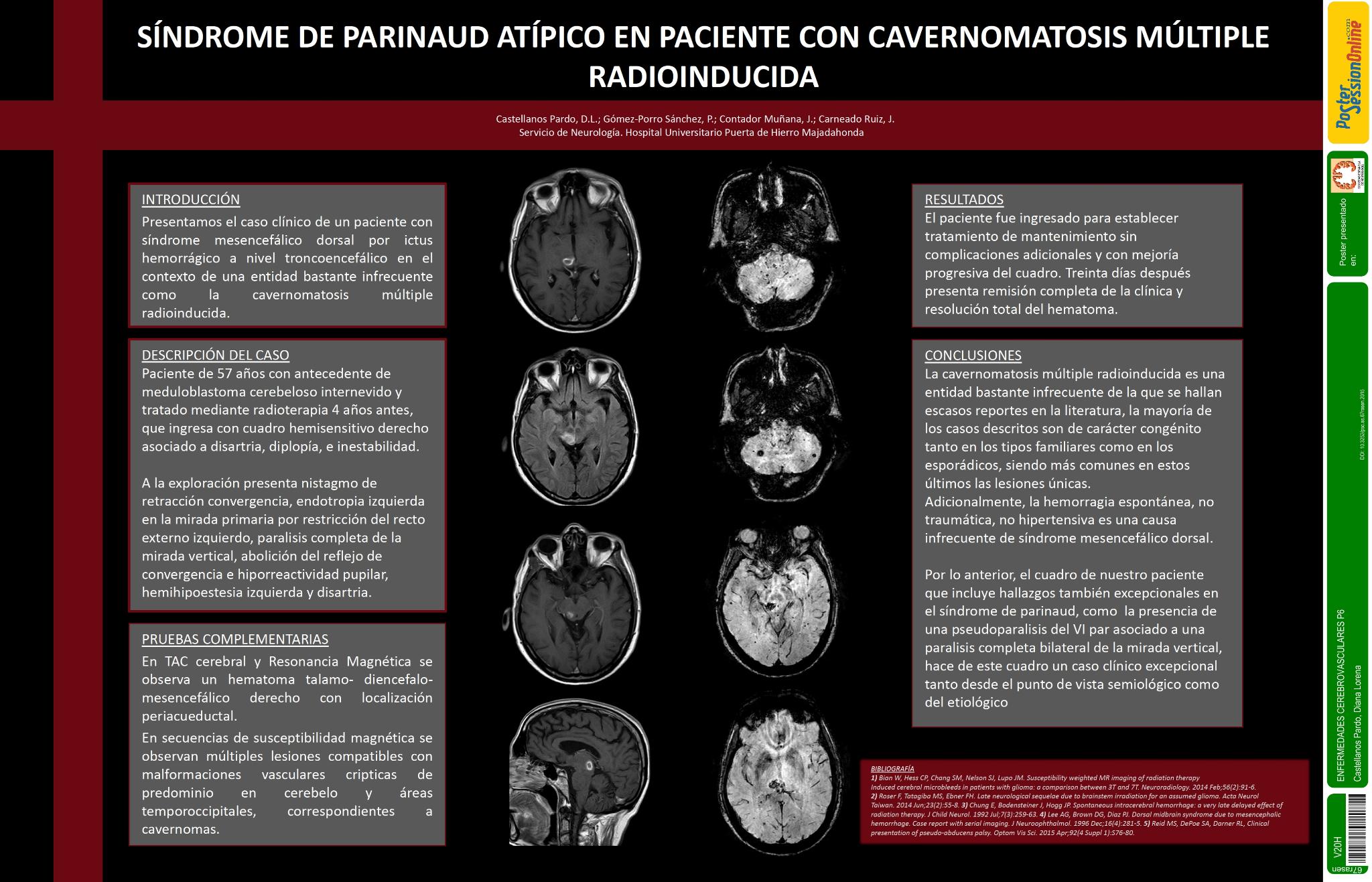 Cavernomatosis múltiple radioinducida que debuta con síndrome de Parinaud atípico