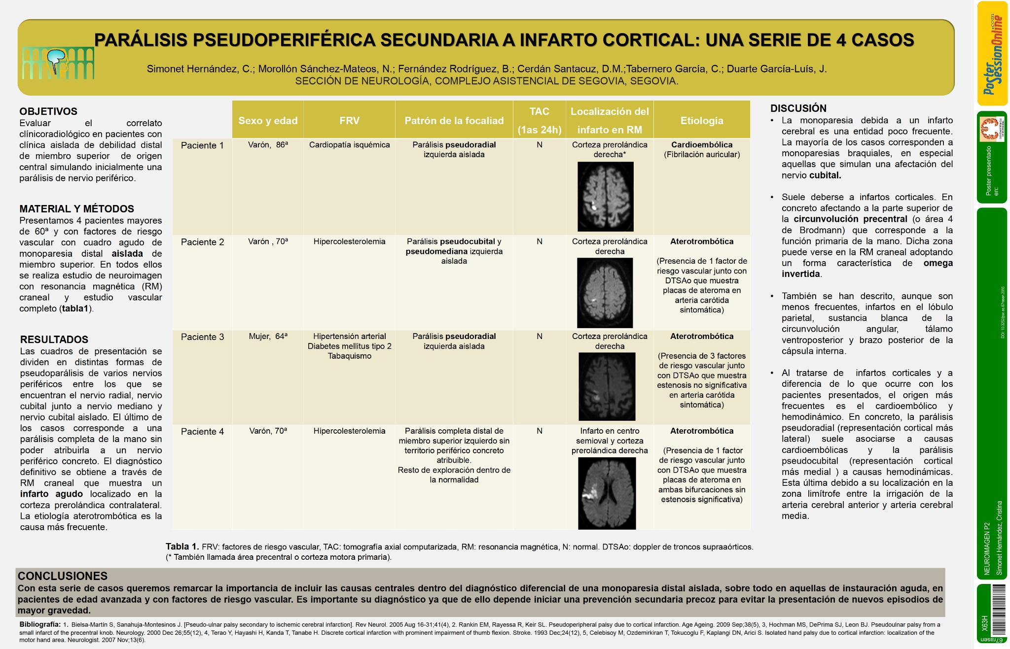 Parálisis pseudoperiférica secundaria a infarto cortical: una serie de 4 casos