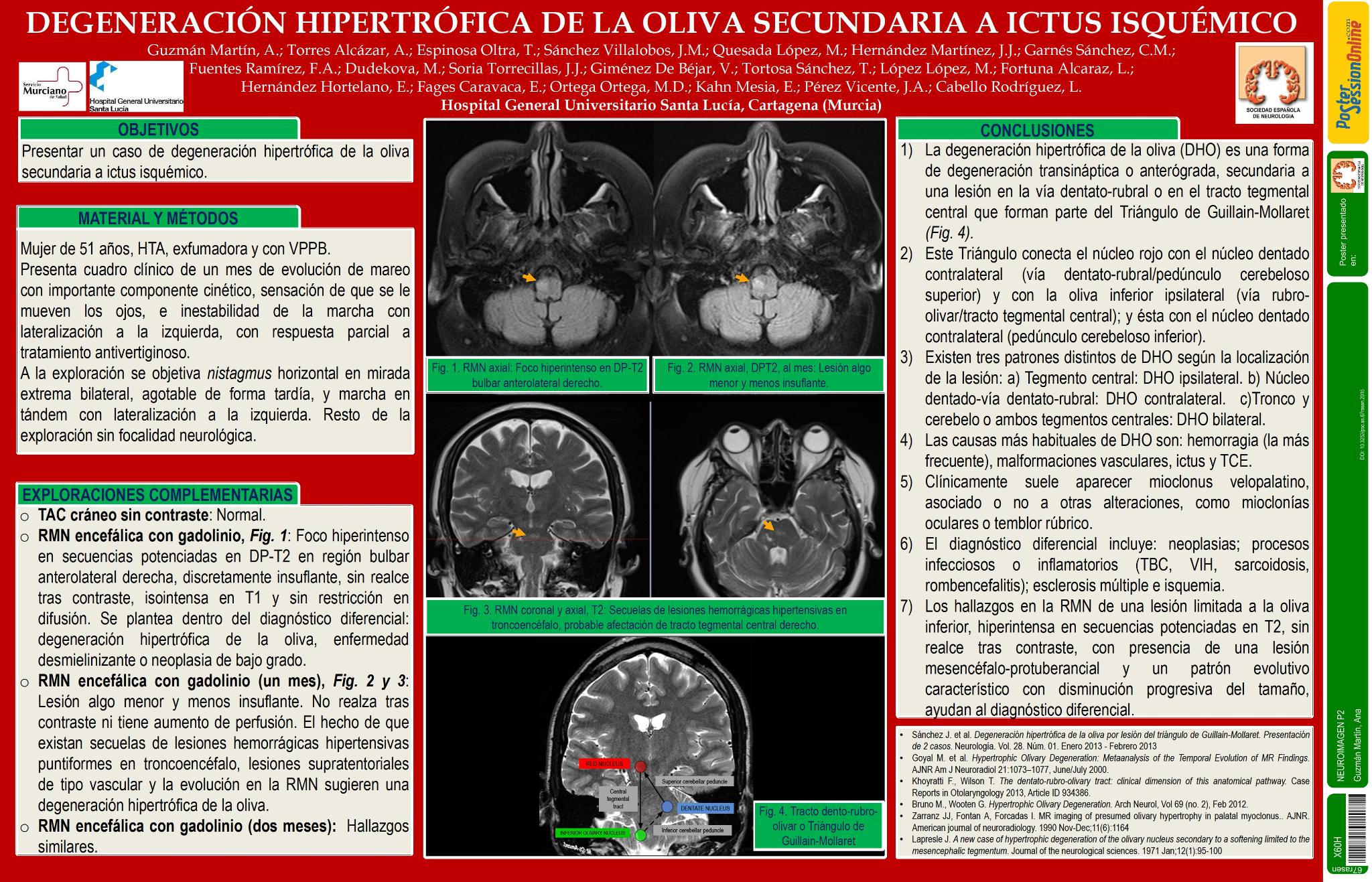 Degeneración hipertrófica de la oliva secundaria a ictus isquémico