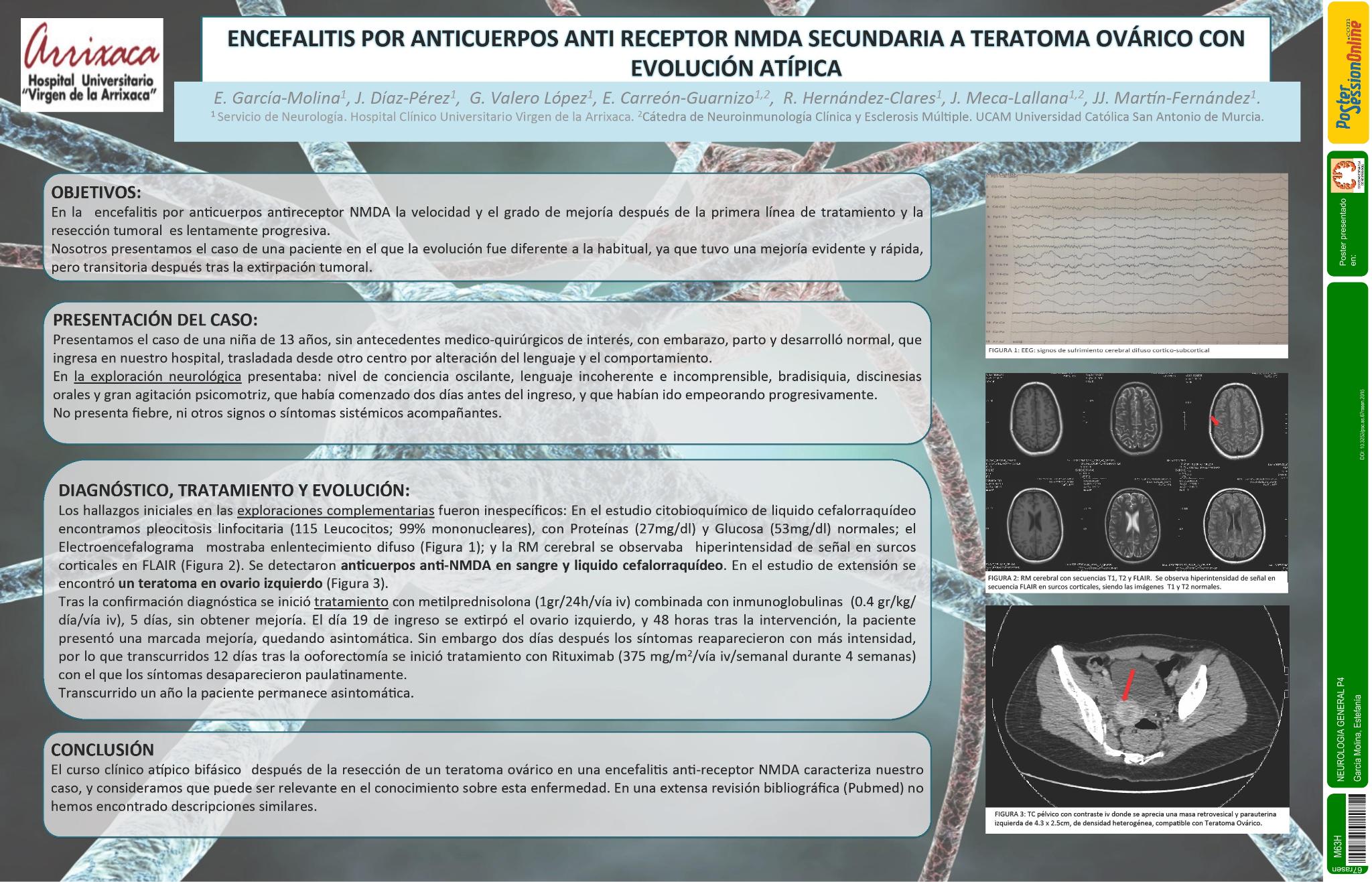 Encefalitis por anticuerpos anti receptor NMDA secundaria a teratoma ovárico con evolución atípica