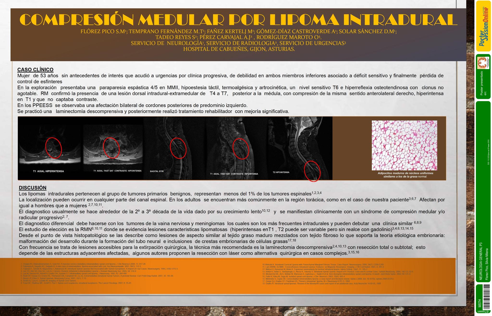 Compresión medular por lipoma intradural