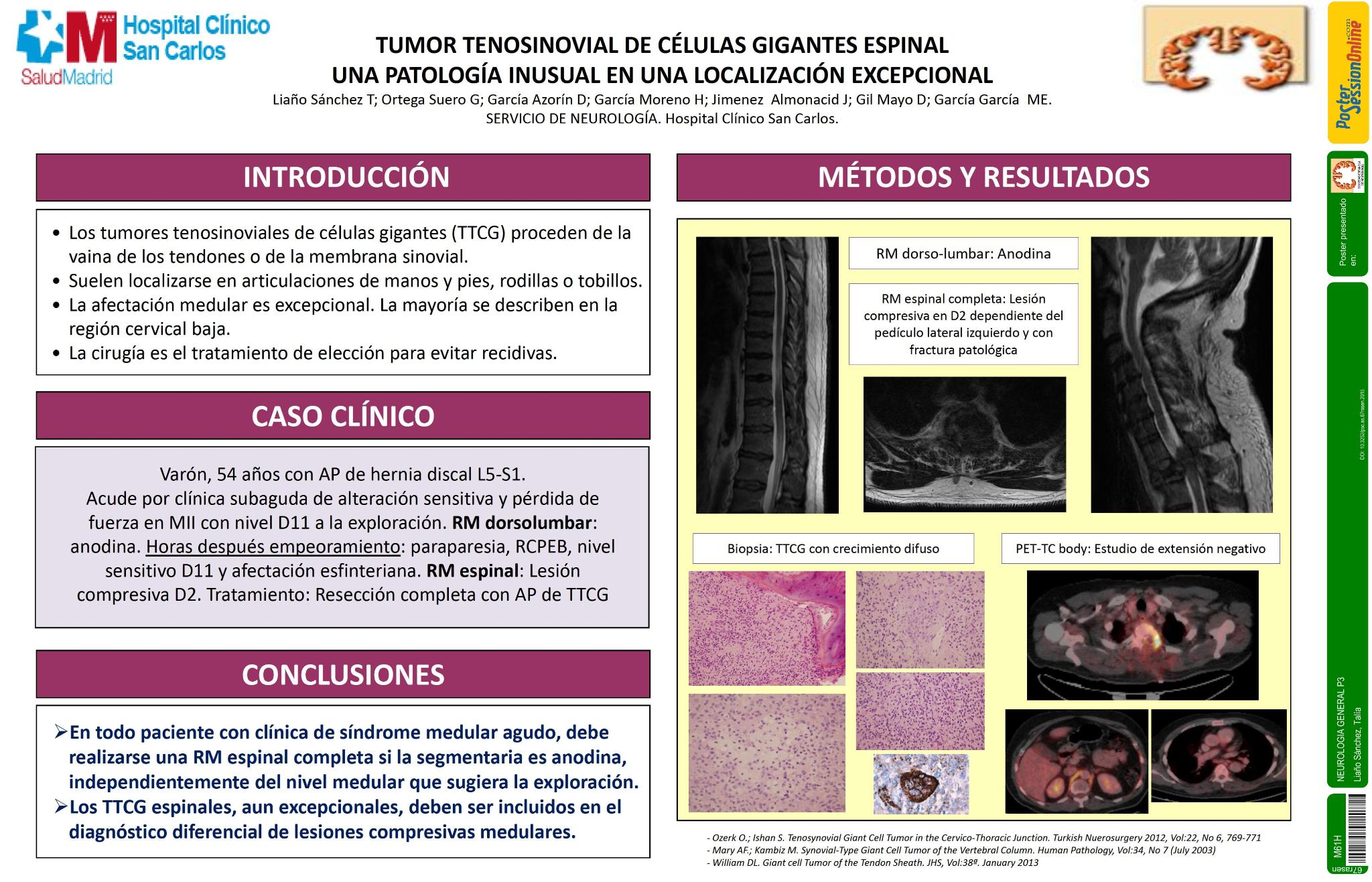 Tumor tenosinovial de células gigantes espinal. Una patología inusual en una localización excepcional