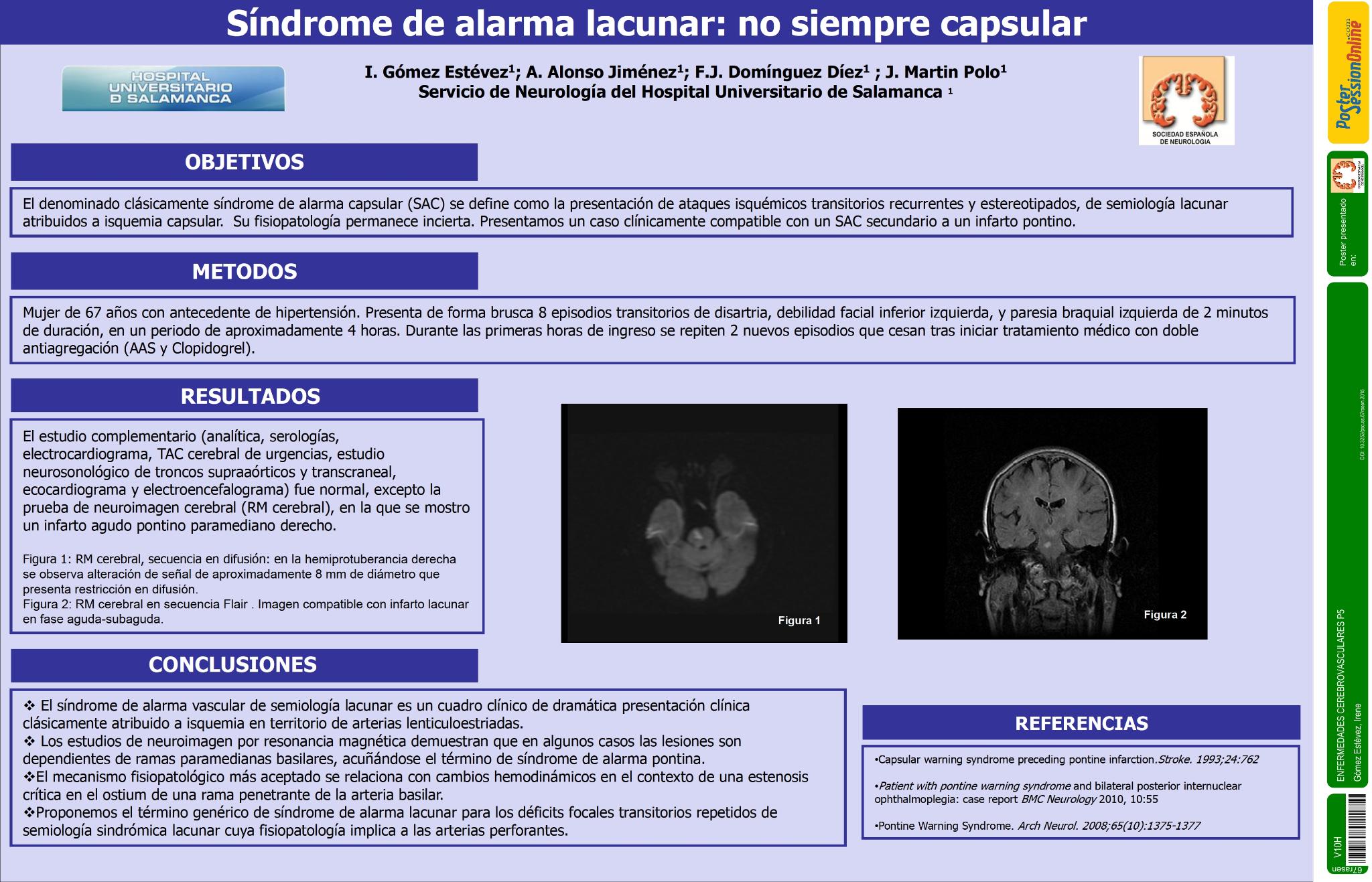 Síndrome de alarma lacunar: no siempre capsular