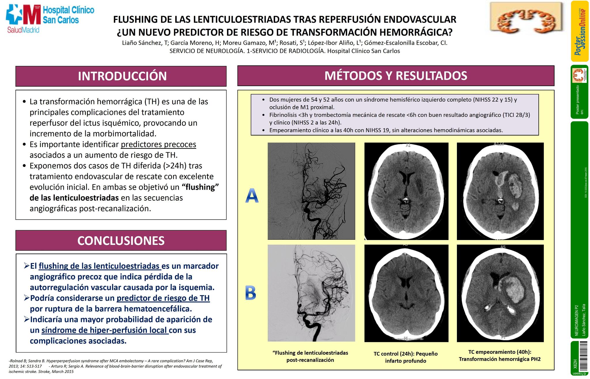 "Flushing" de las lenticuloestriadas tras reperfusión endovascular ¿Un nuevo predictor de riesgo de transformación hemorrágica?