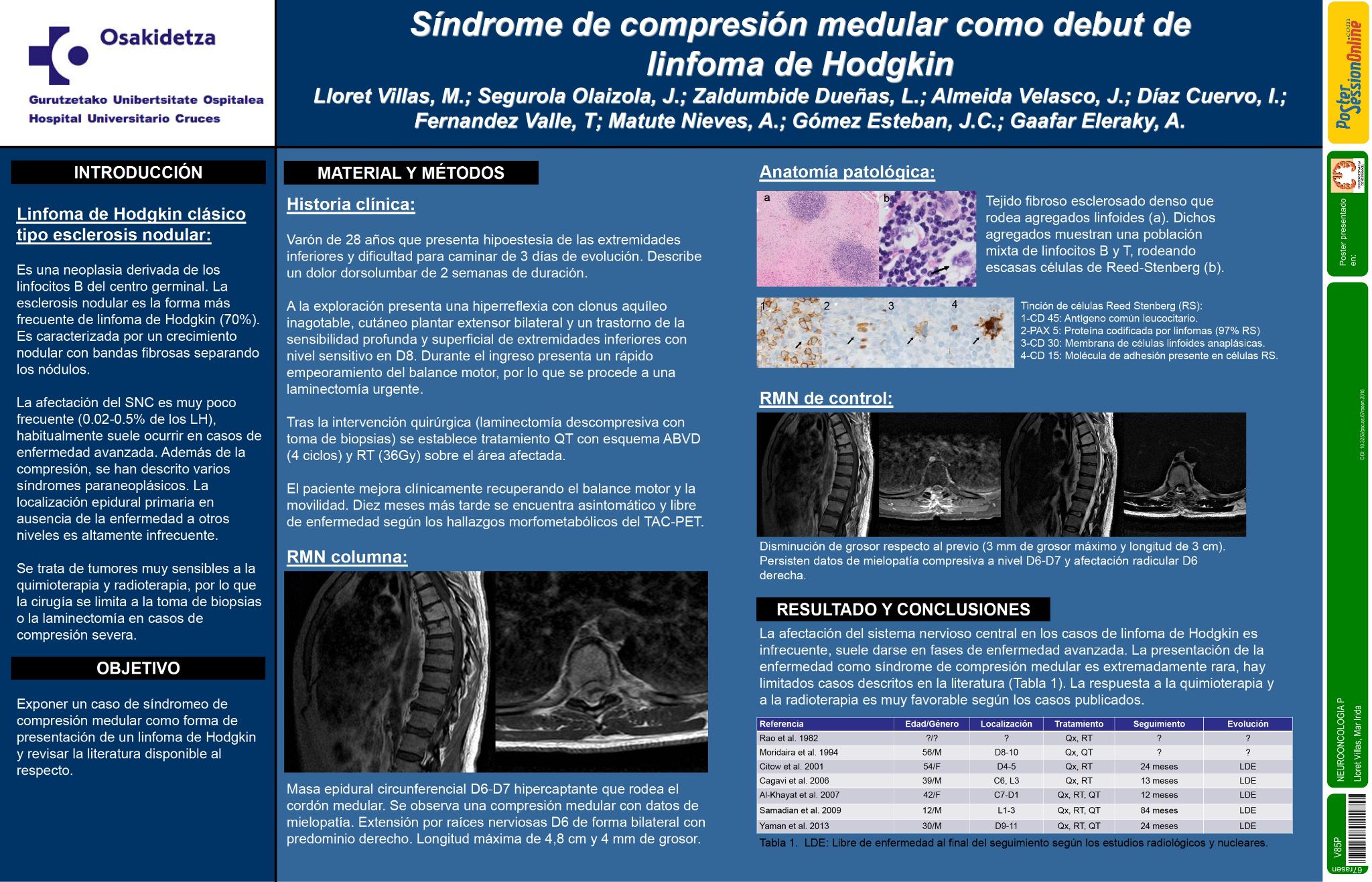 Síndrome de compresión medular como debut de Linfoma de Hodgkin