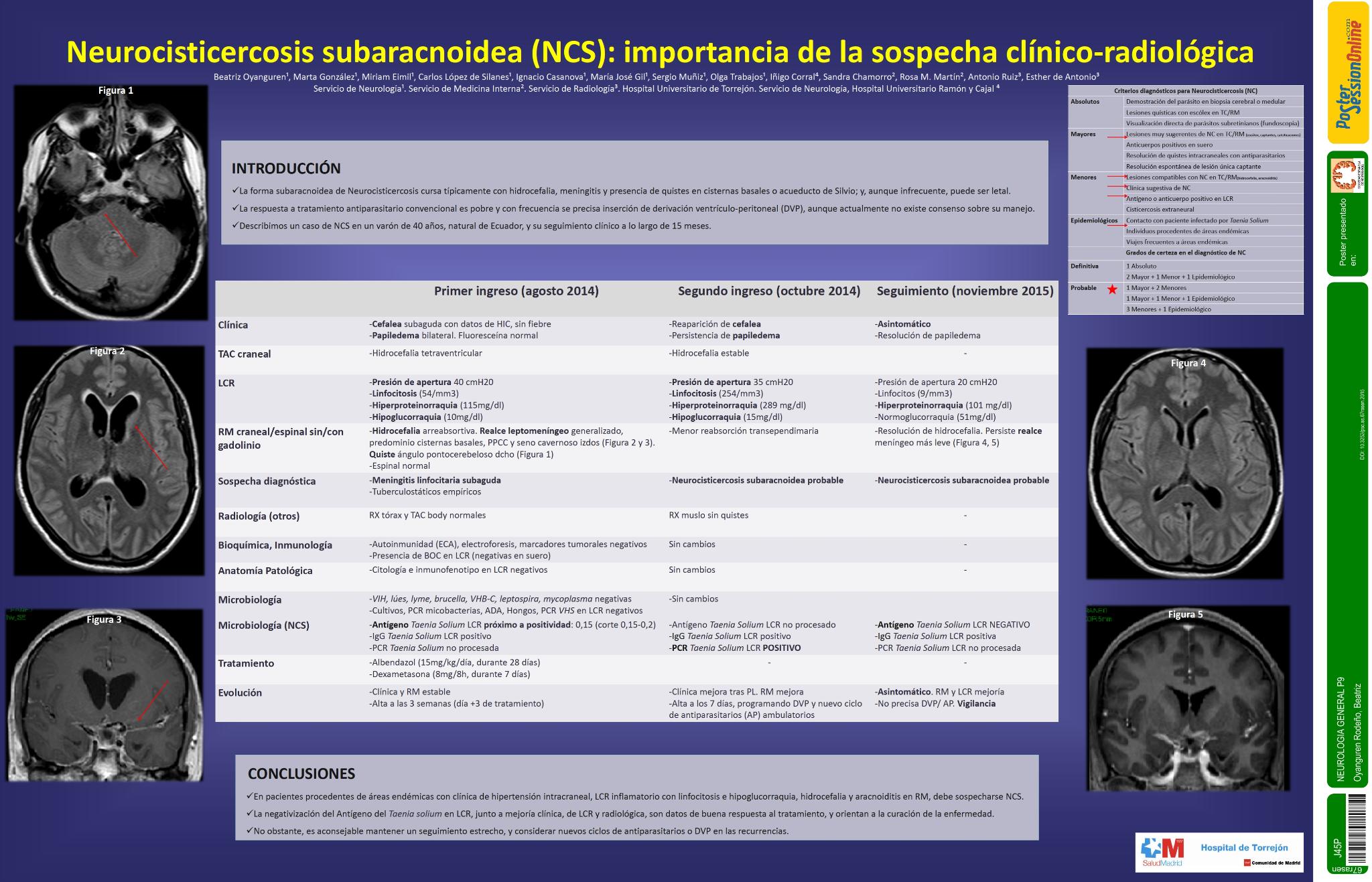 Neurocisticercosis subaracnoidea (NCS): importancia de la sospecha clínico-radiológica