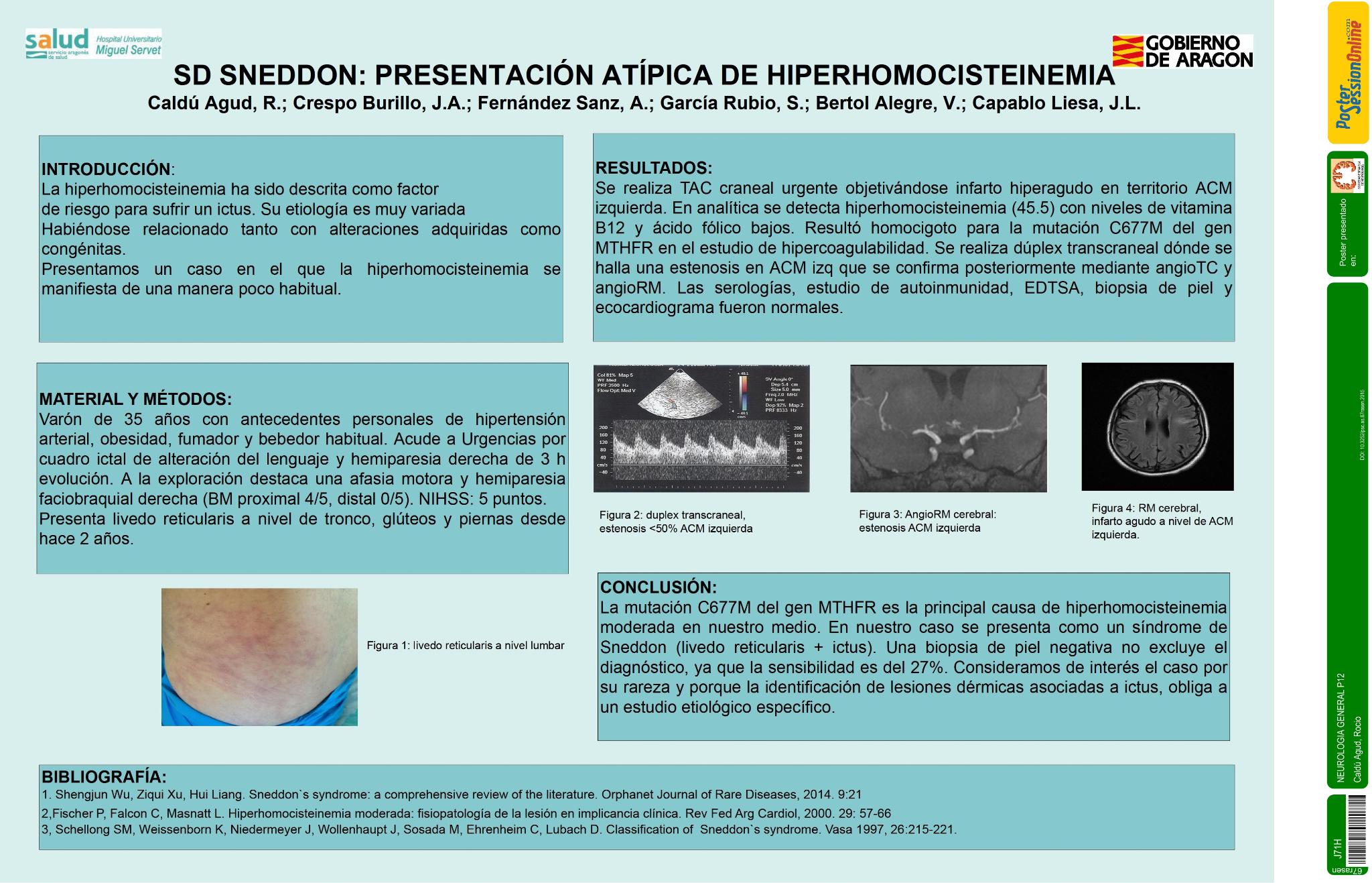 Síndrome de Sneddon: presentación atípica de hiperhomocisteinemia