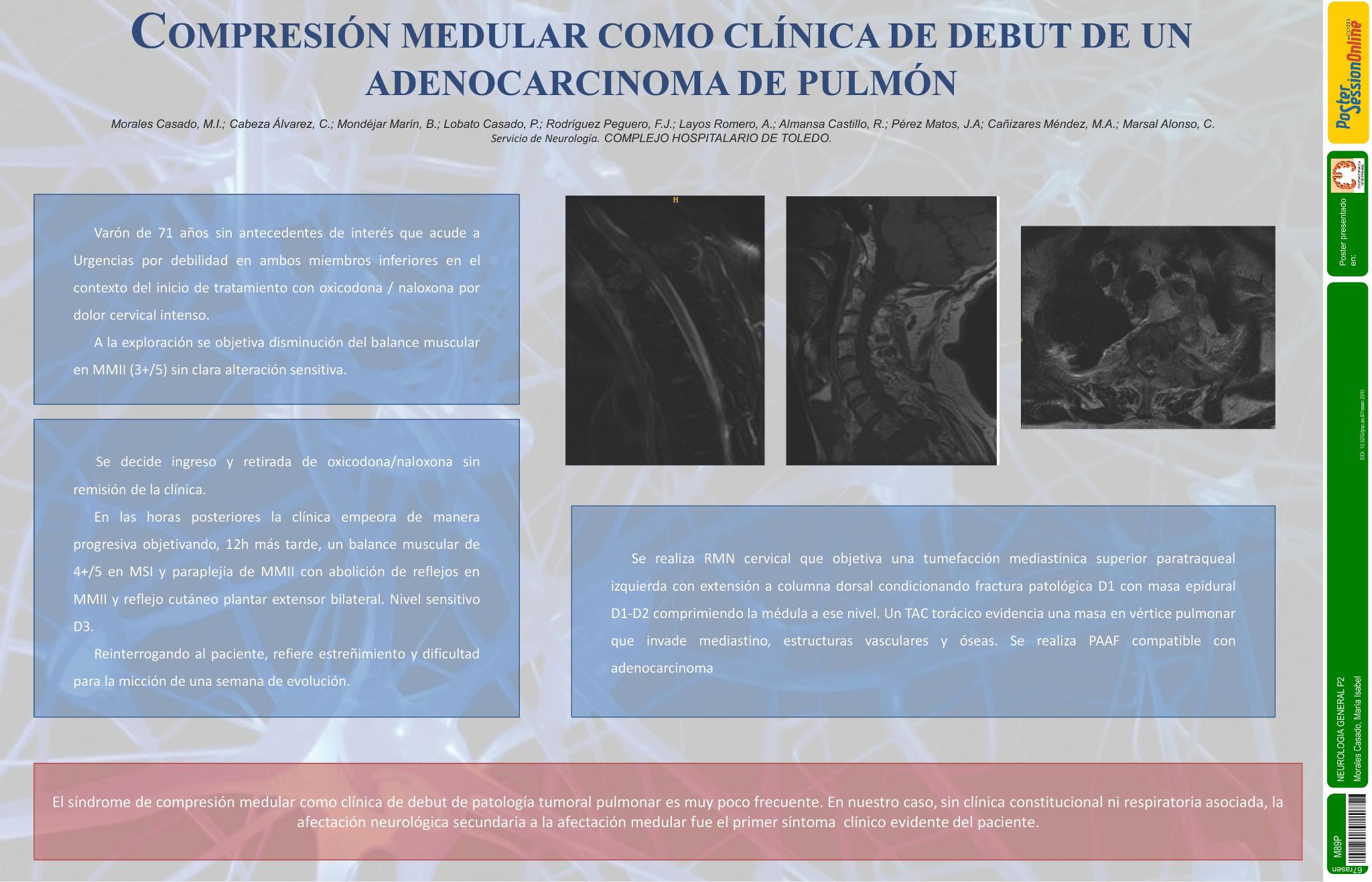 Compresión medular como clínica de debut de un adenocarcinoma de pulmón