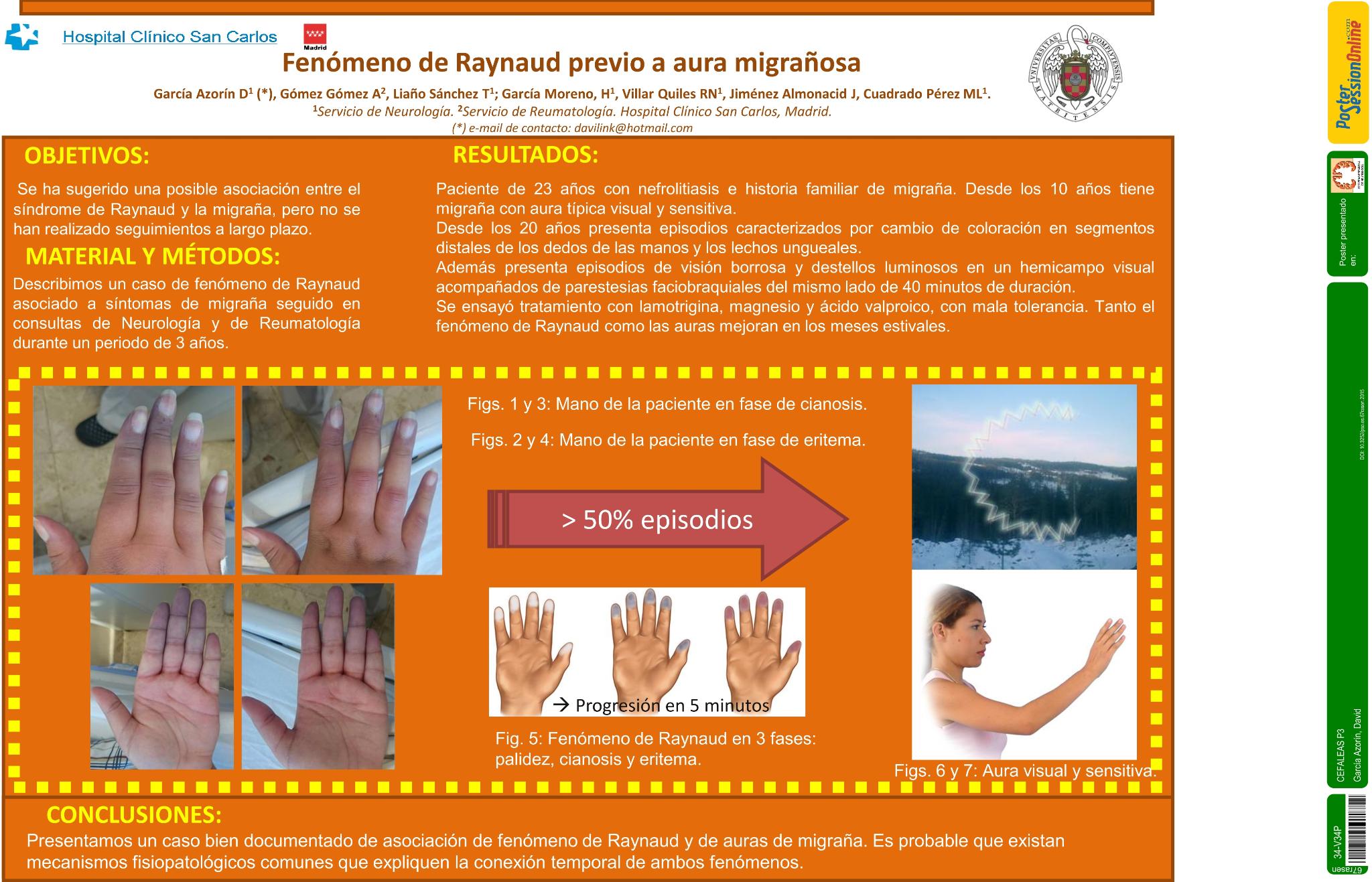 Fenómeno de Raynaud previo a aura migrañosa