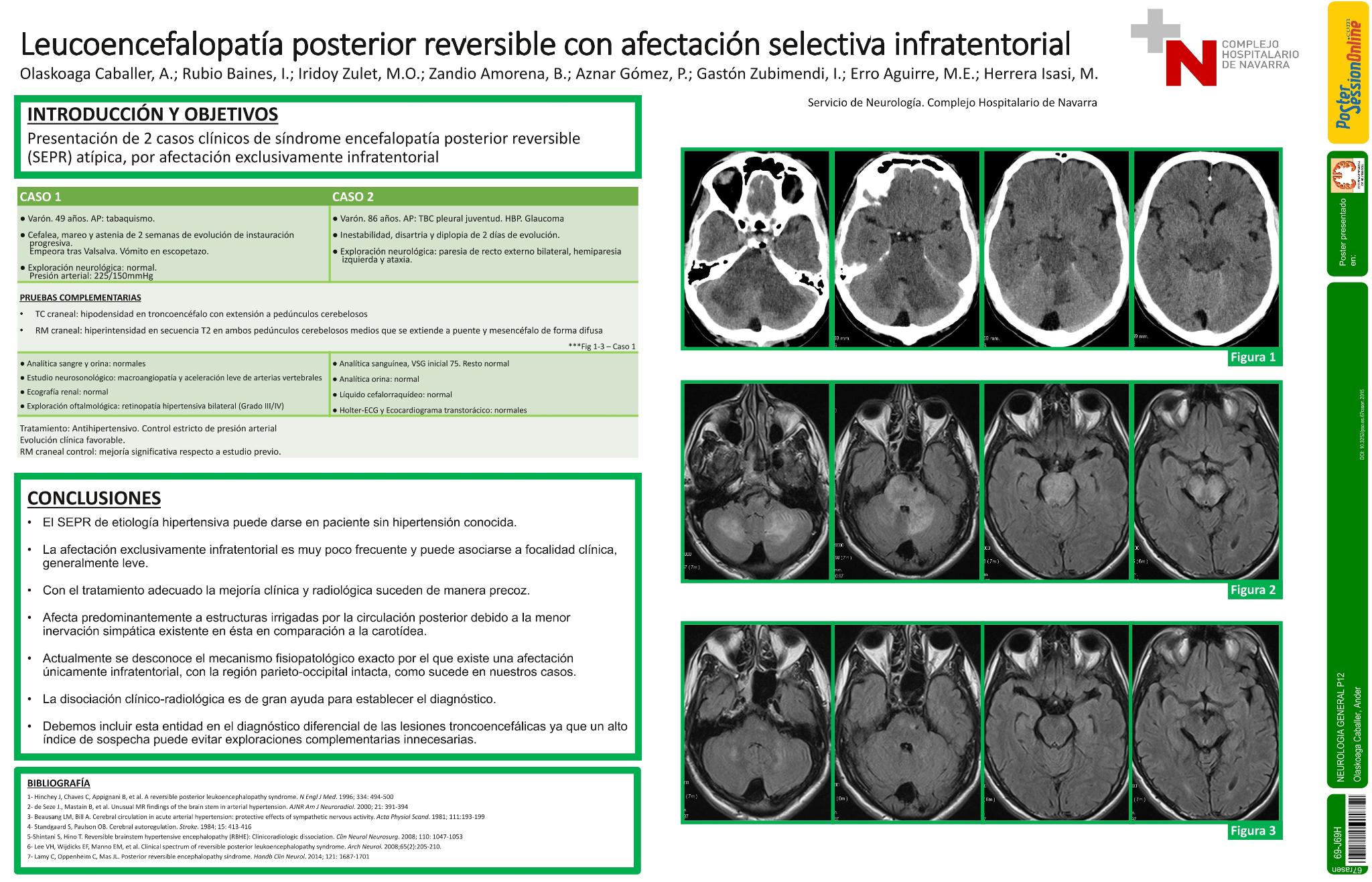 Leucoencefalopatía posterior reversible con afectación selectiva infratentorial