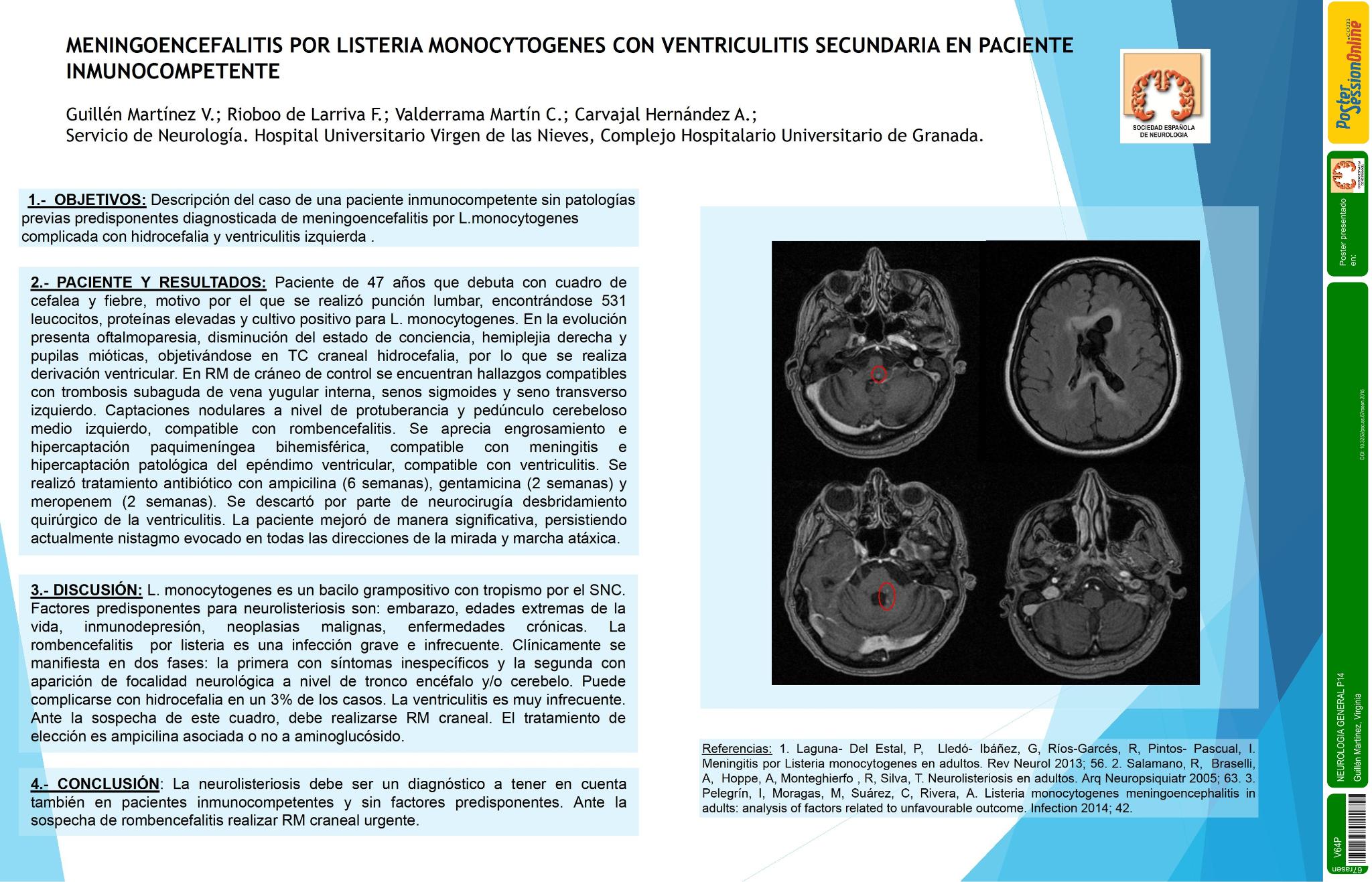 Meningoencefalitis por Listeria monocytogenes con ventriculitis secundaria en paciente inmunocompetente