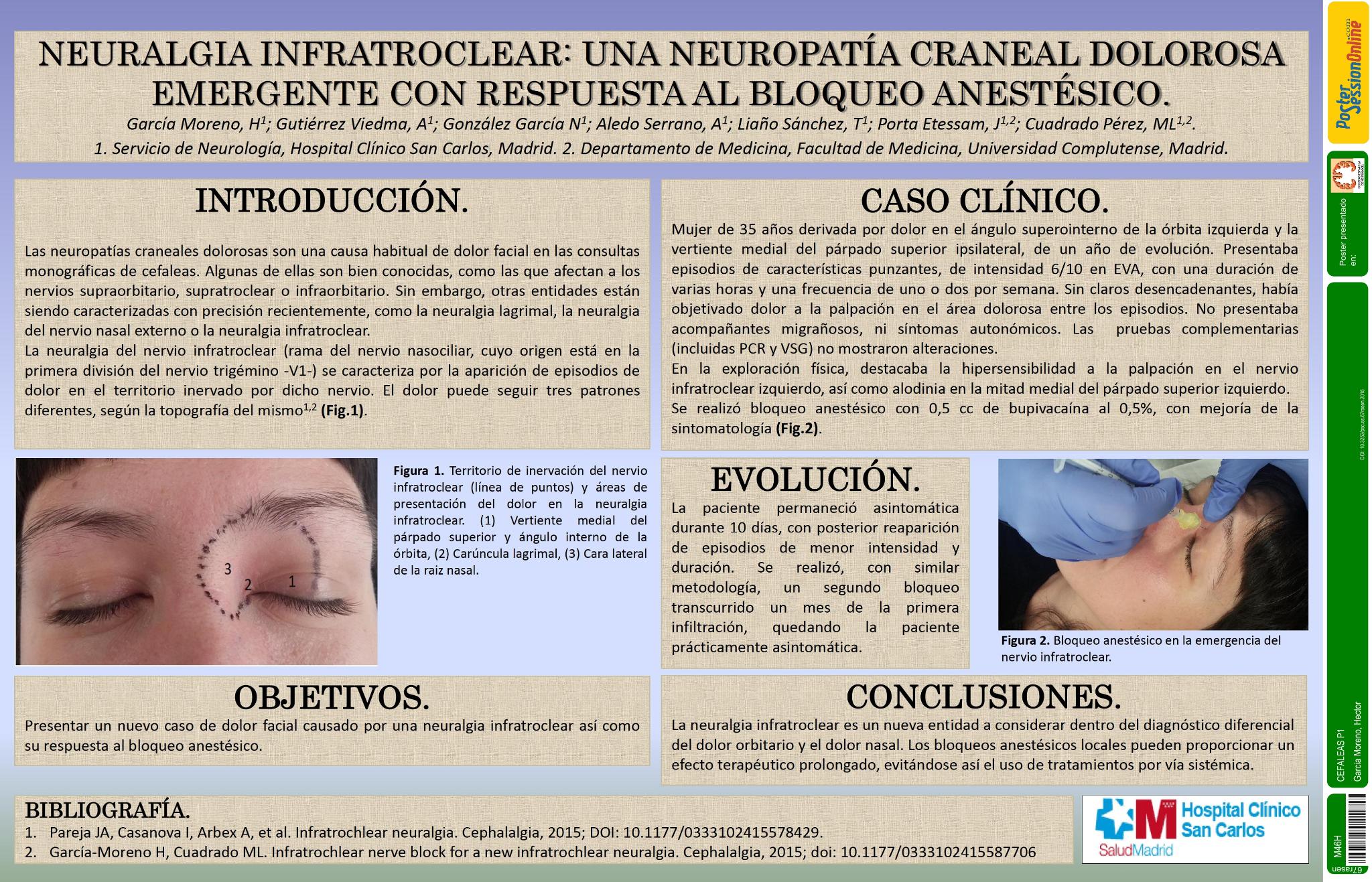 Neuralgia infratroclear: una neuropatía craneal dolorosa emergente con respuesta al bloqueo anestésico