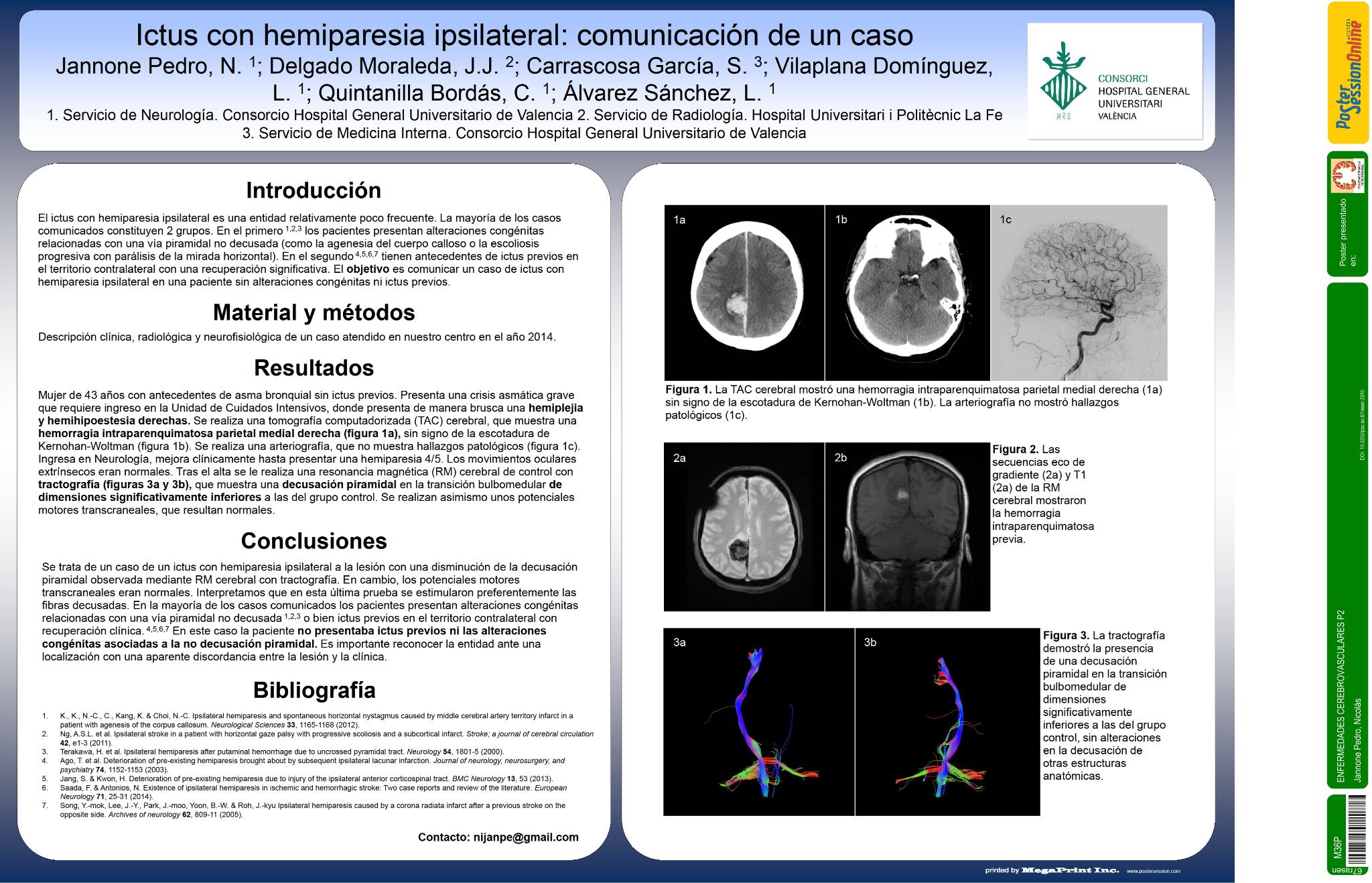 Ictus con hemiparesia ipsilateral: comunicación de un caso