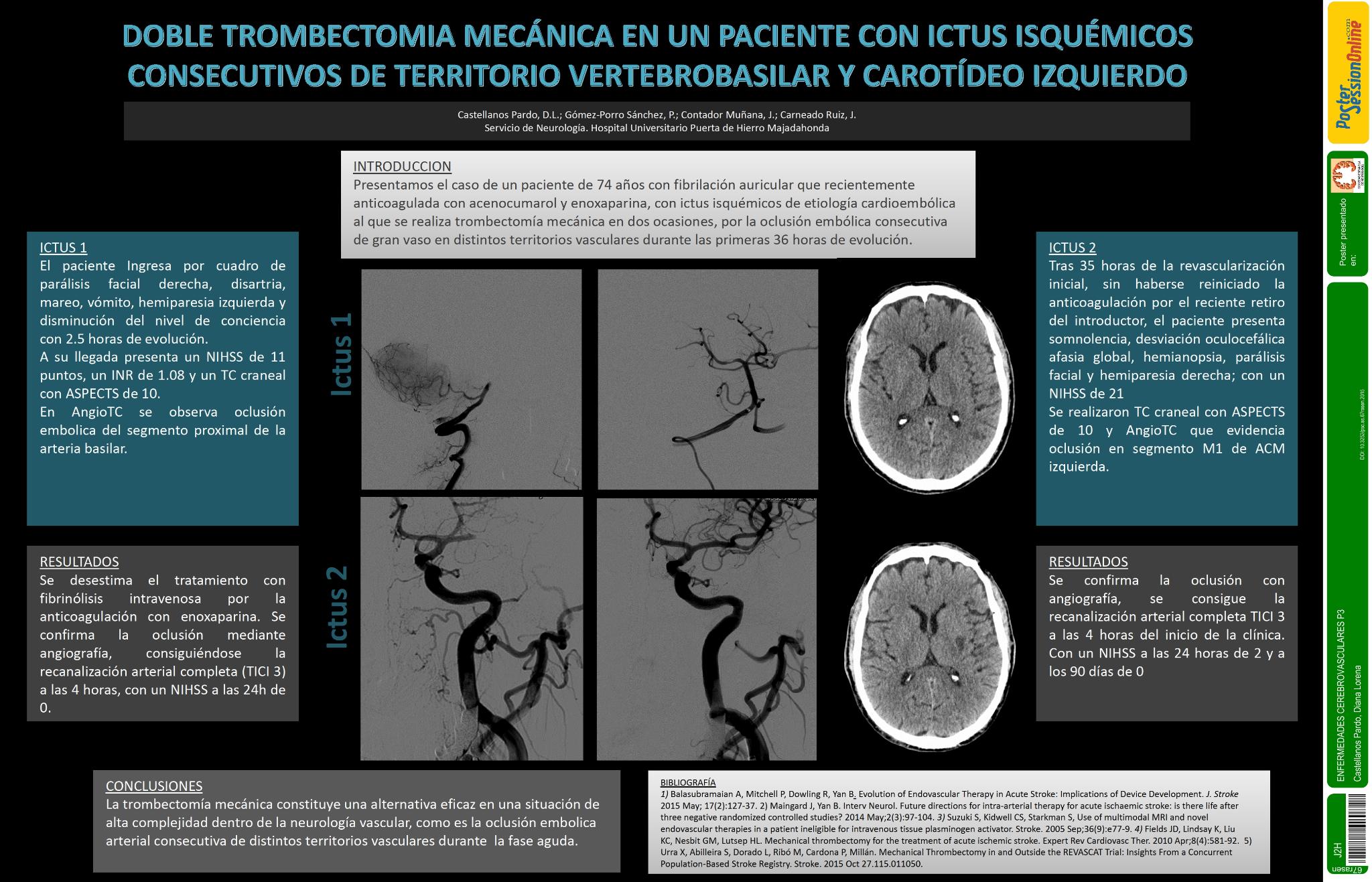Doble trombectomia mecánica en un paciente con ictus isquémicos consecutivos de territorio vertebrobasilar y carotídeo izquierdo de etiología cardioembólica