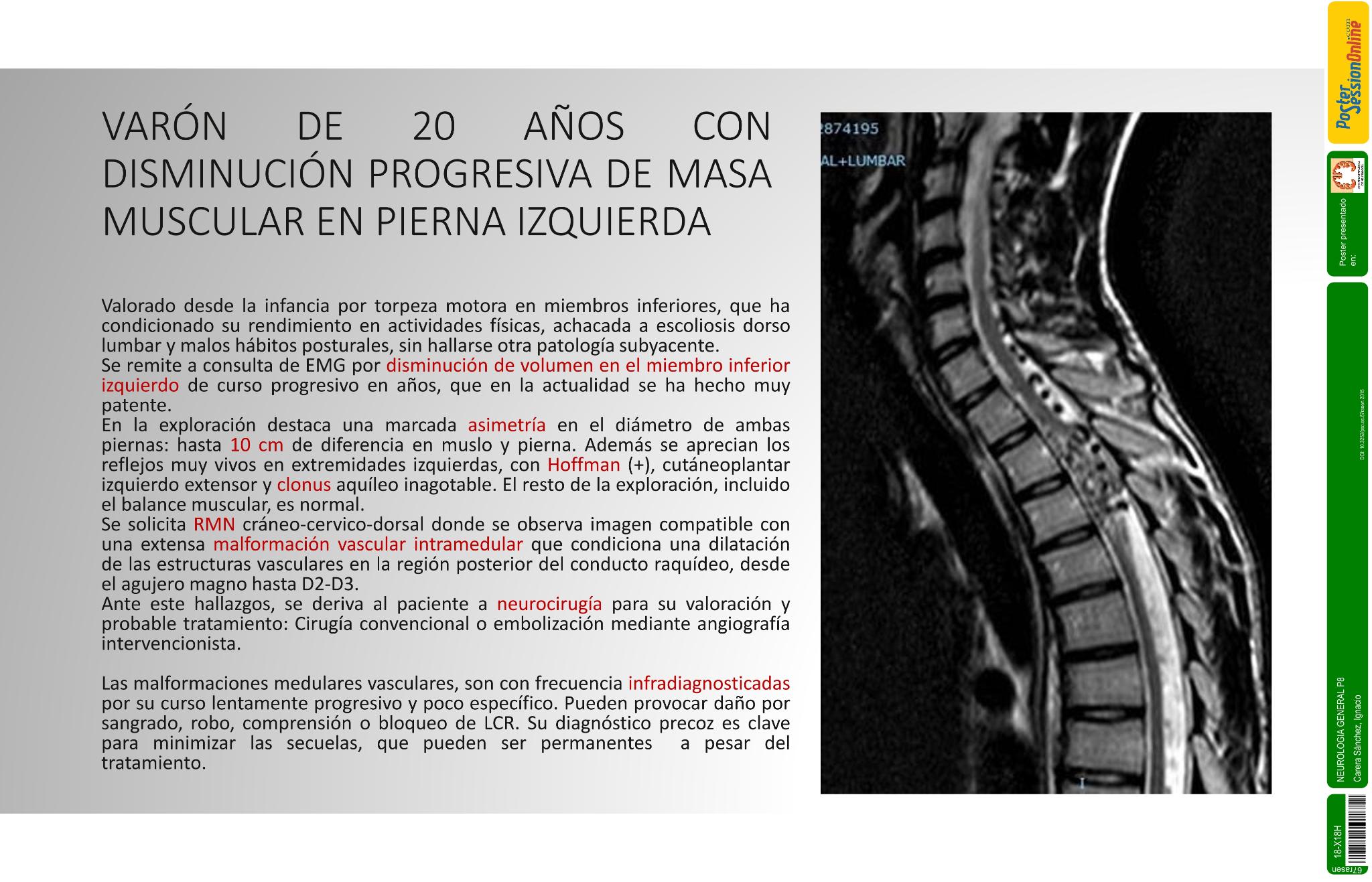 Varón de 20 años con disminución progresiva de masa muscular en pierna izquierda