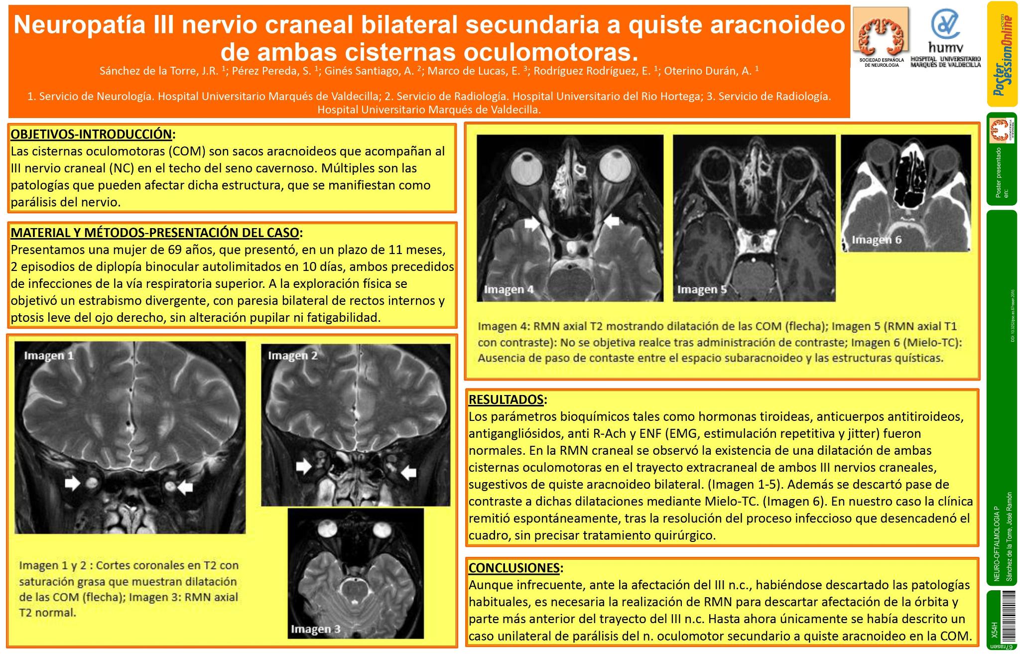 Neuropatía III nervio craneal bilateral secundaria a quiste aracnoideo de ambas cisternas oculomotoras