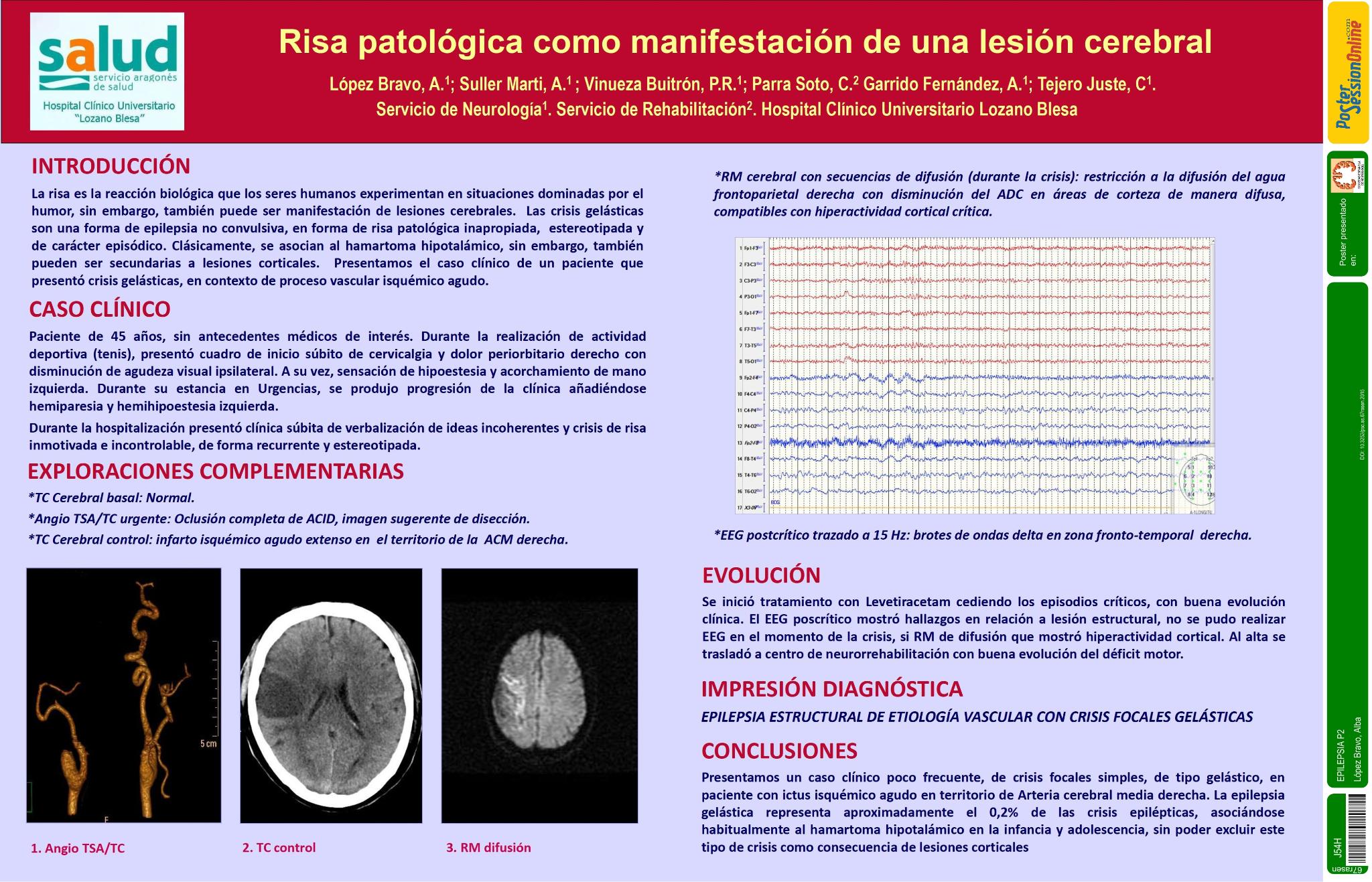 Risa patológica como manifestación de una lesión cerebral. A propósito de un caso