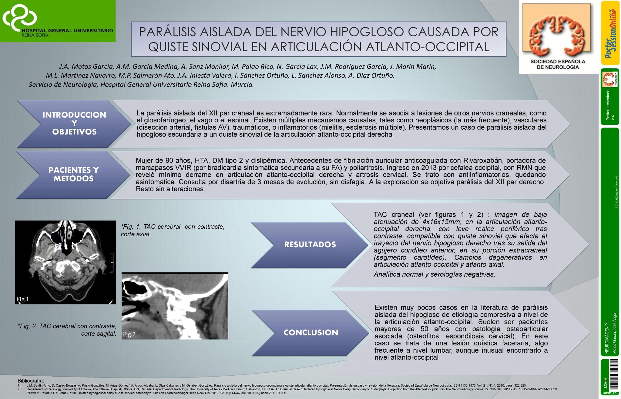 Parálisis aislada del nervio hipogloso causada por quiste sinovial en articulación atlanto-occipital