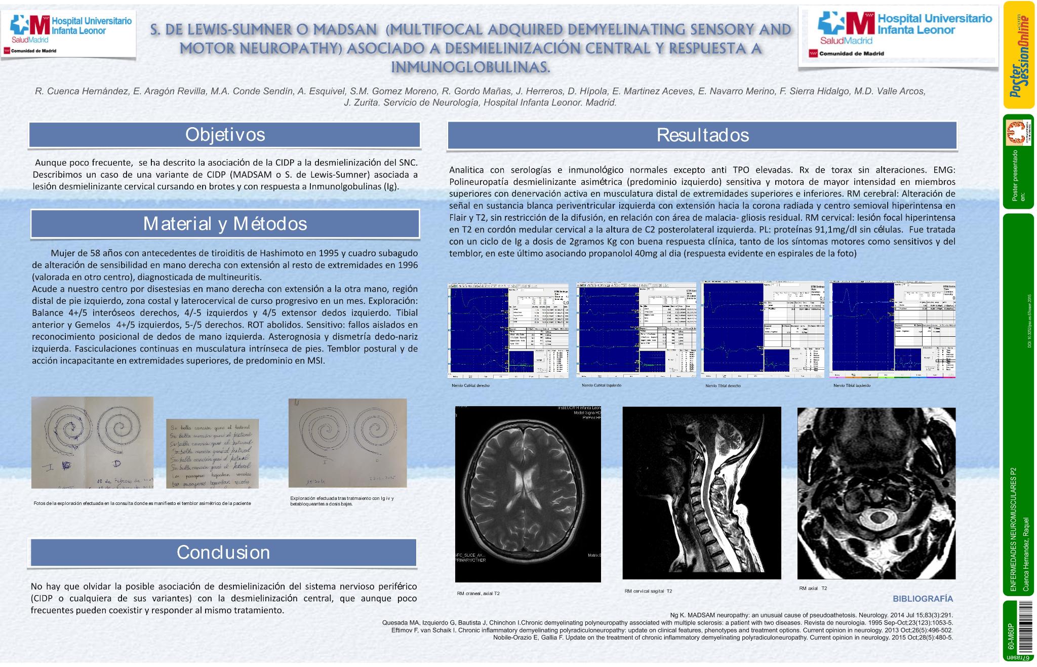 Síndrome de Lewis-Sumner o MADSAM  (multifocal adquired demyelinating sensory and motor neuropathy) asociado a desmielinización central y respuesta a Inmunoglobulinas (Ig)