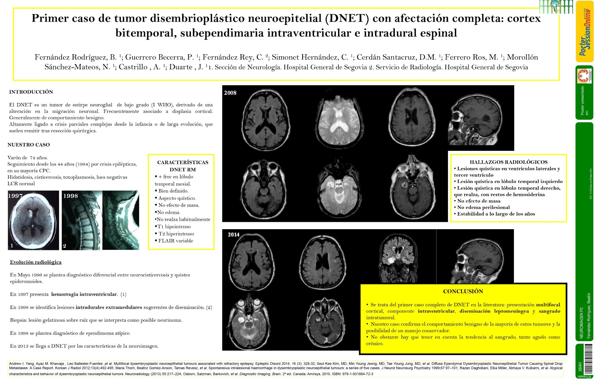 Primer caso de tumor disembrioplástico neuroepitelial (DNET) con afectación completa: cortex bitemporal, subependimaria intaventricular  e intradural espinal