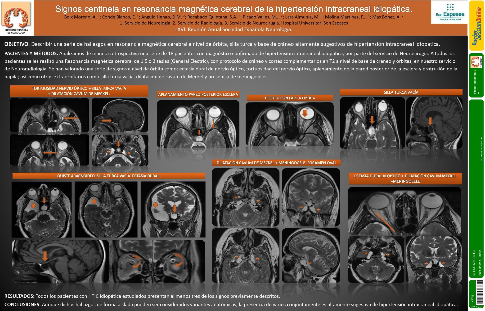 Signos centinela en resonancia magnética cerebral de la hipertensión intracraneal idiopática