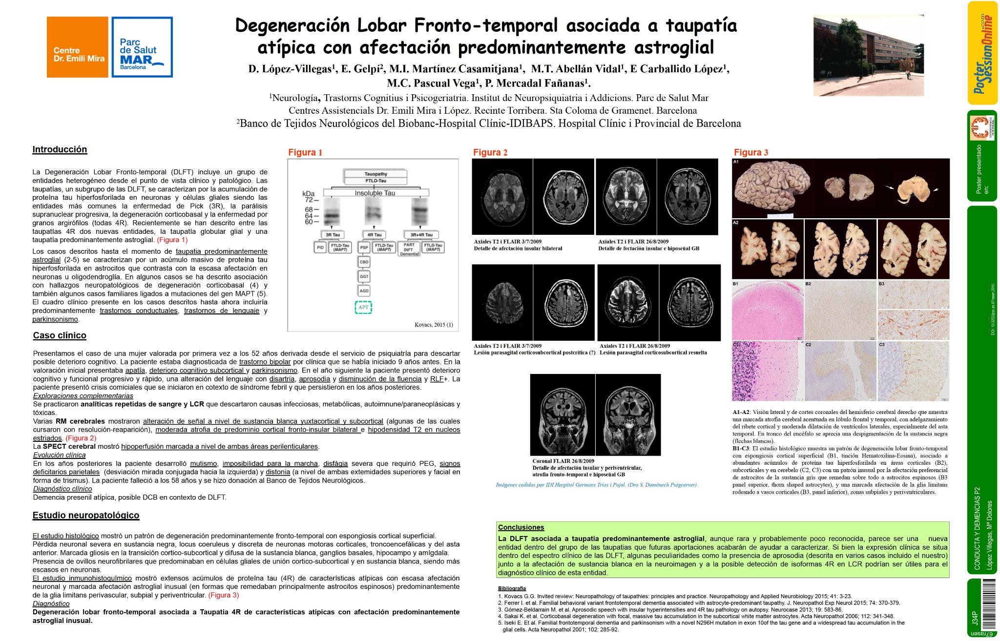 Degeneración lobar fronto-temporal asociada a taupatía atípica con afectación predominantemente astroglial