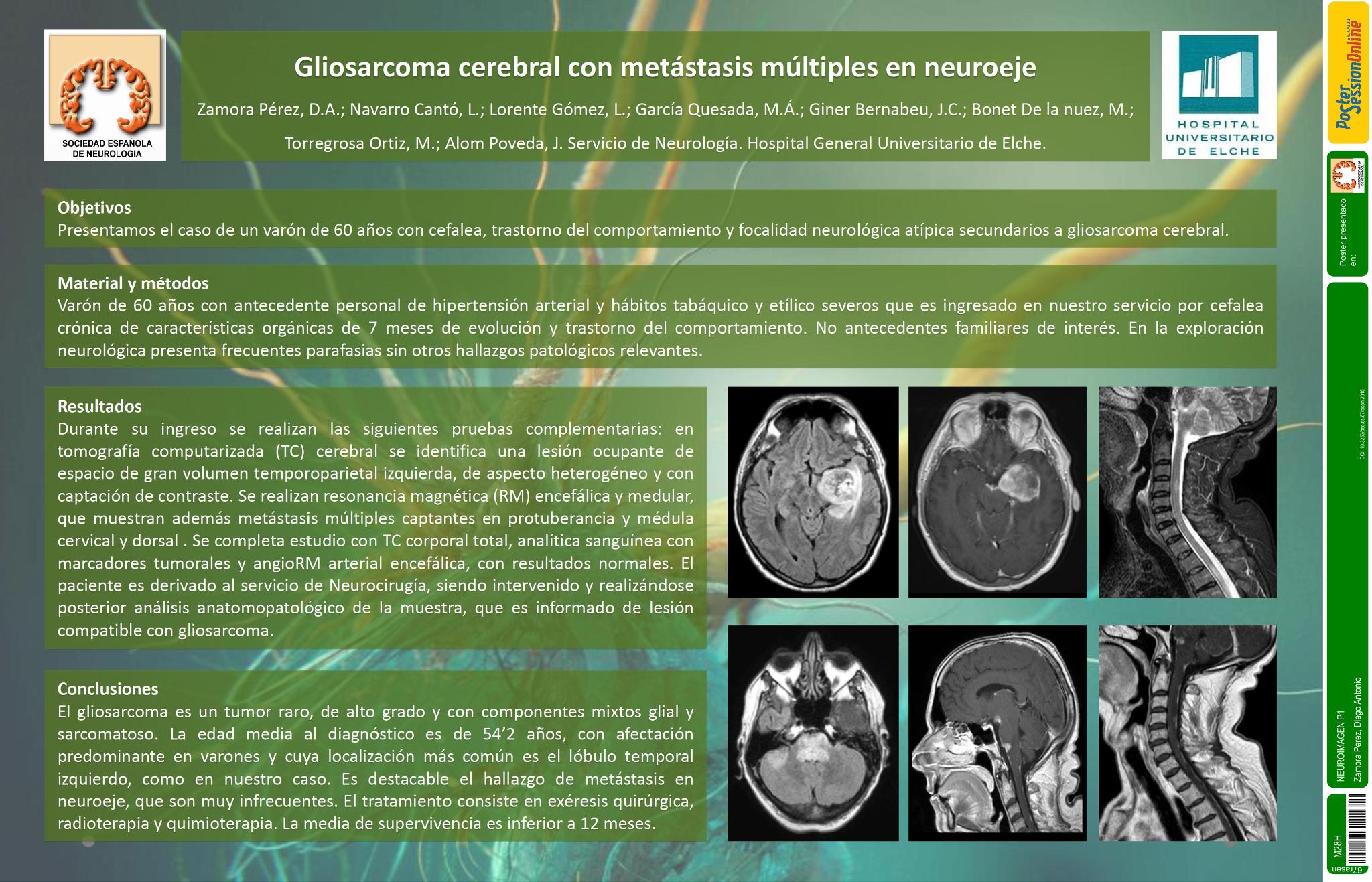 Gliosarcoma cerebral con metástasis múltiples en neuroeje