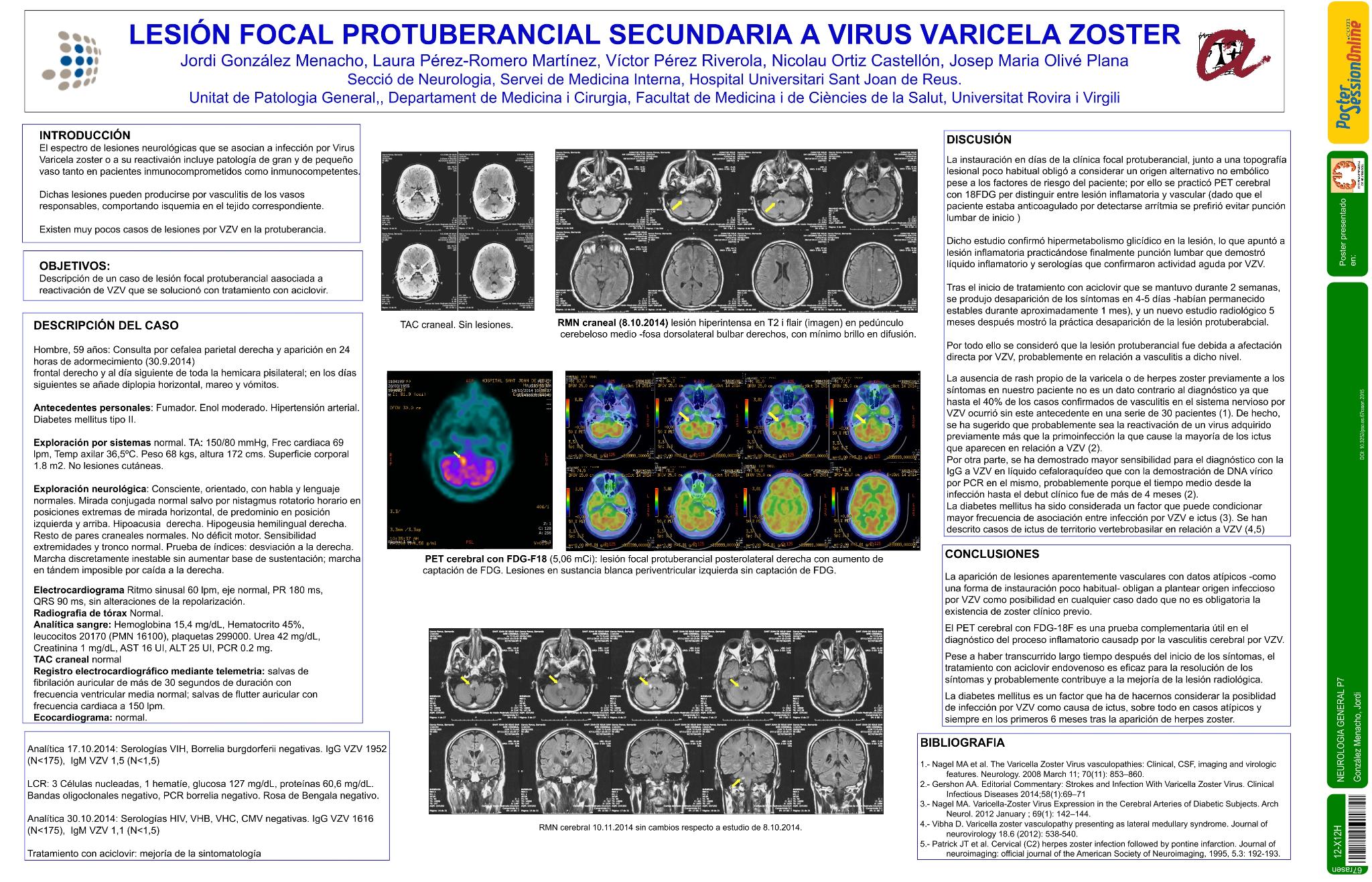 Lesión focal protuberancial secundaria a Virus Varicela Zoster