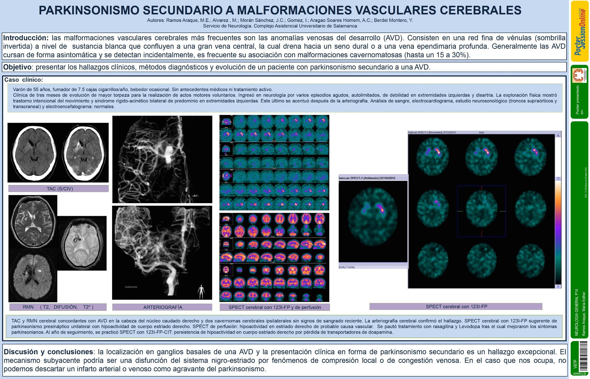 Parkinsonismo secundario a malformaciones vasculares cerebrales