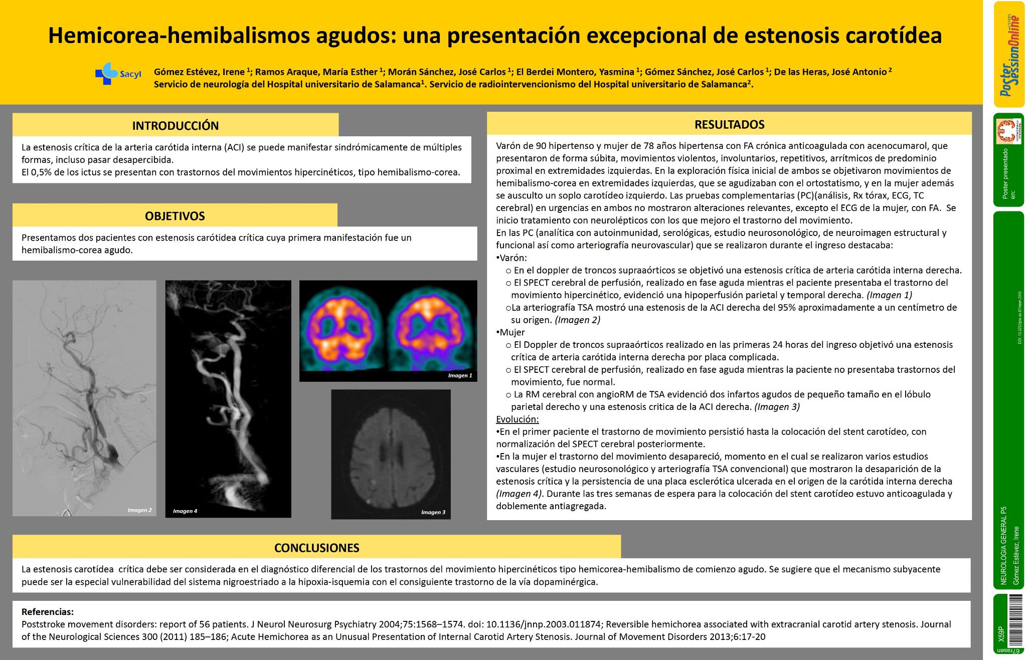 Hemicorea-hemibalismos agudos: una presentación excepcional de estenosis carotídea