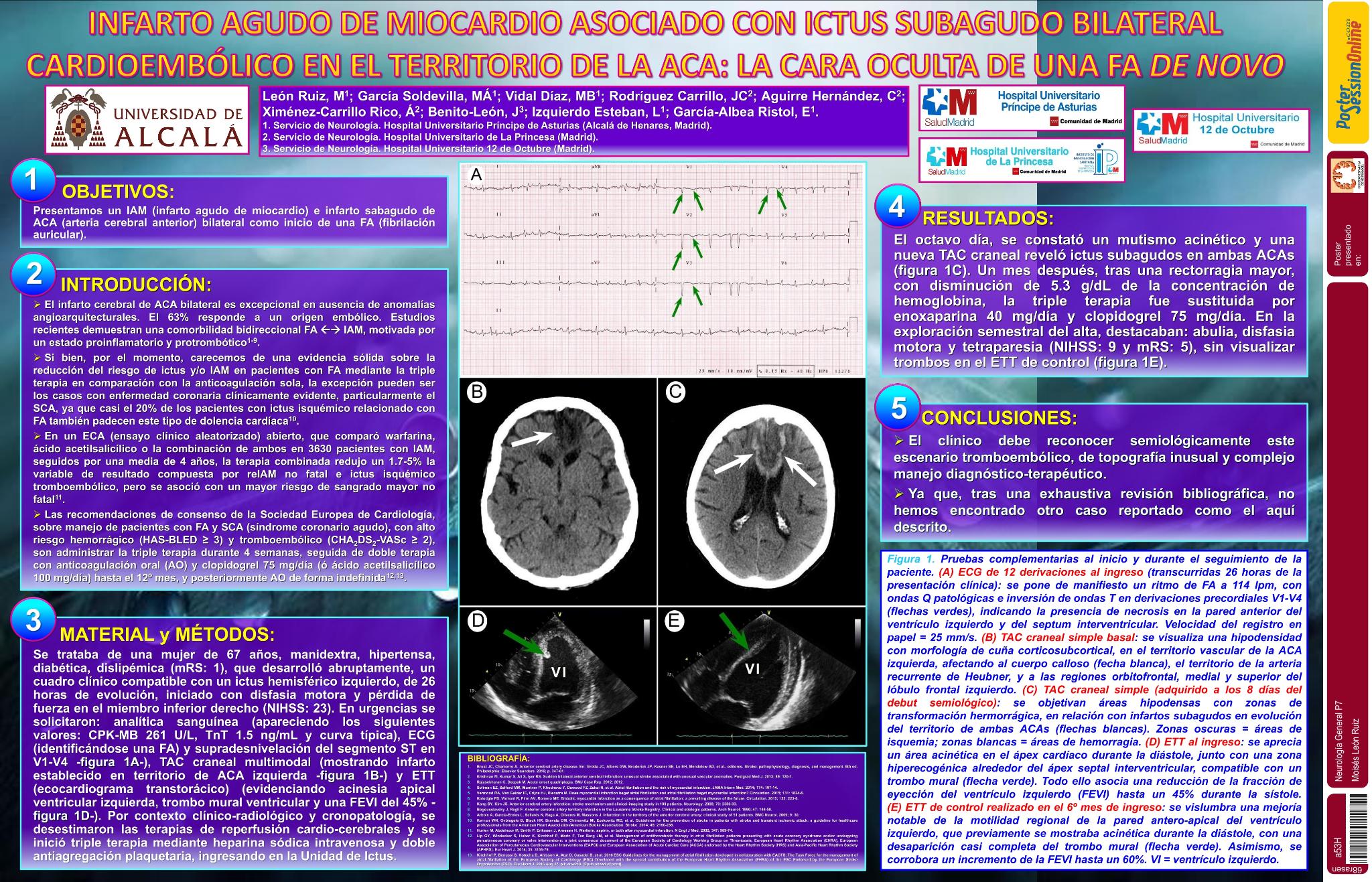 Infarto agudo de miocardio asociado con ictus subagudo bilateral cardioembólico en el territorio de la ACA (arteria cerebral anterior): La cara oculta de una FA (fibrilación auricular) de novo