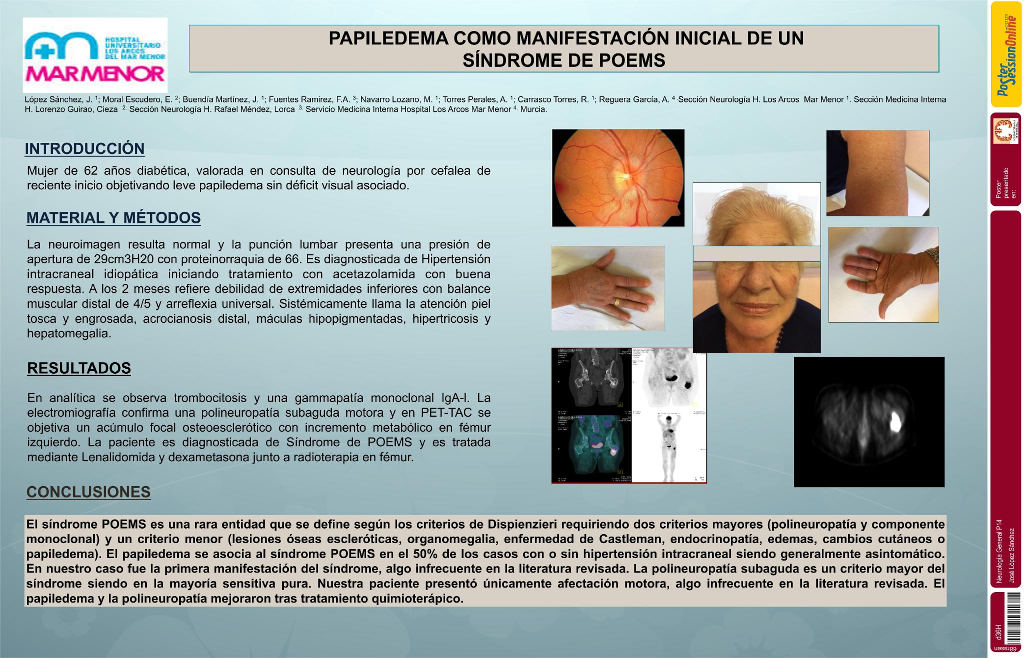 Papiledema como manifestación inicial de un Síndrome de POEMS