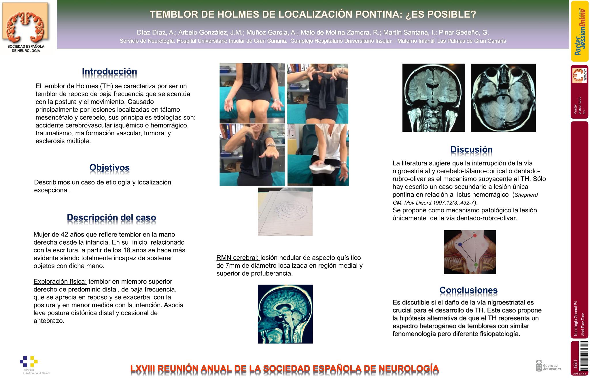 Temblor de Holmes de localización pontina: ¿es posible?