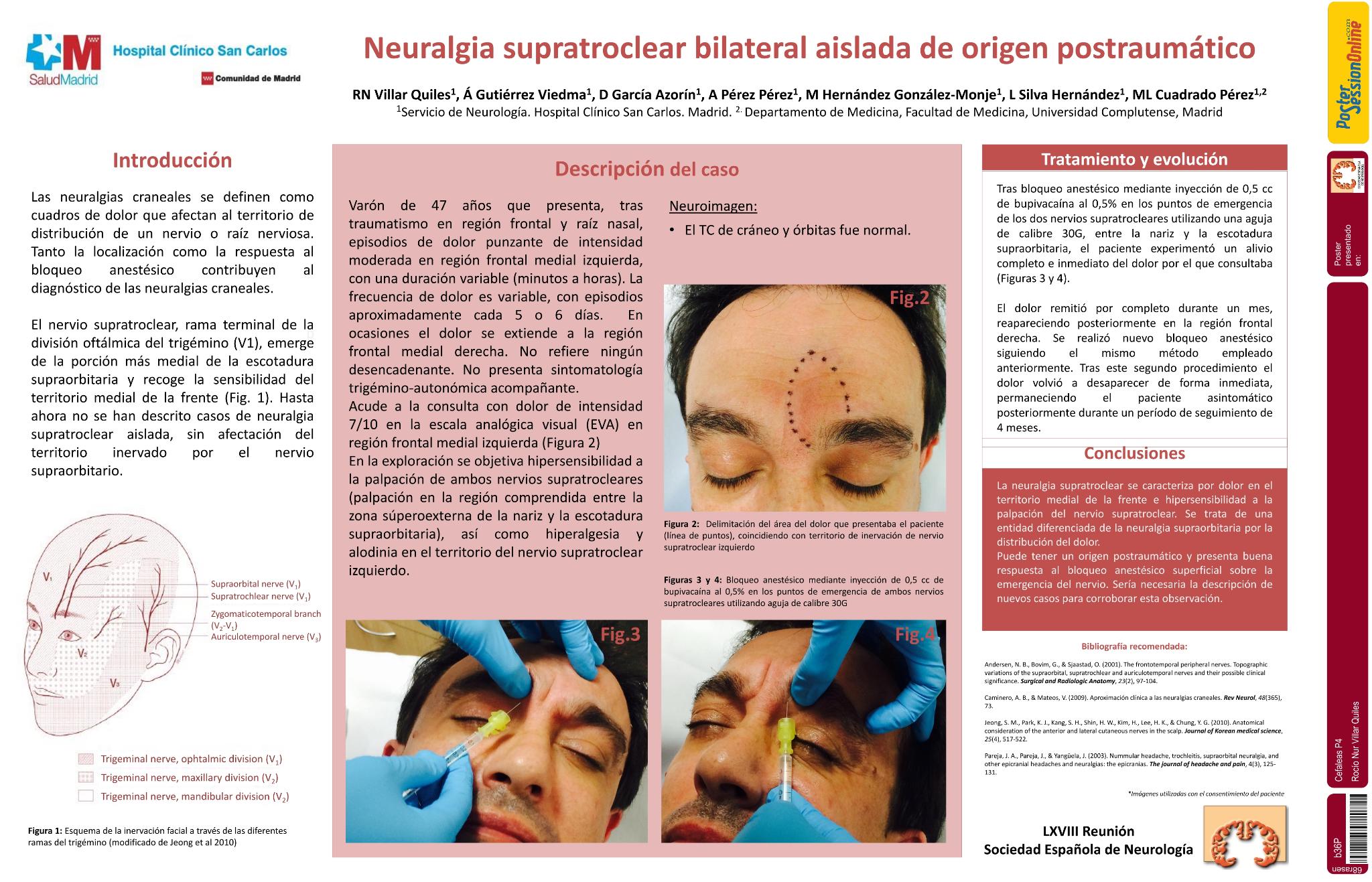 Neuralgia supratroclear bilateral aislada de origen postraumático