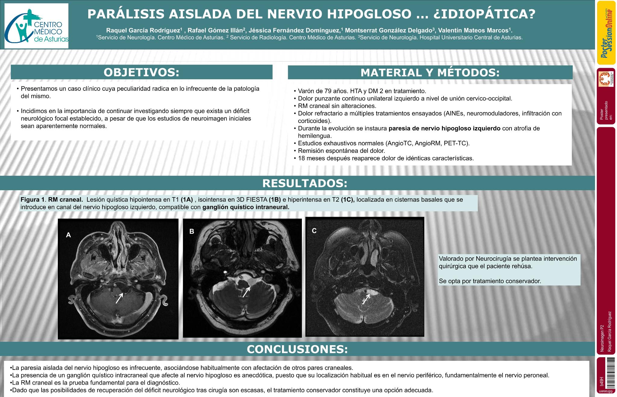 Parálisis aislada de nervio hipogloso...¿idiopática?