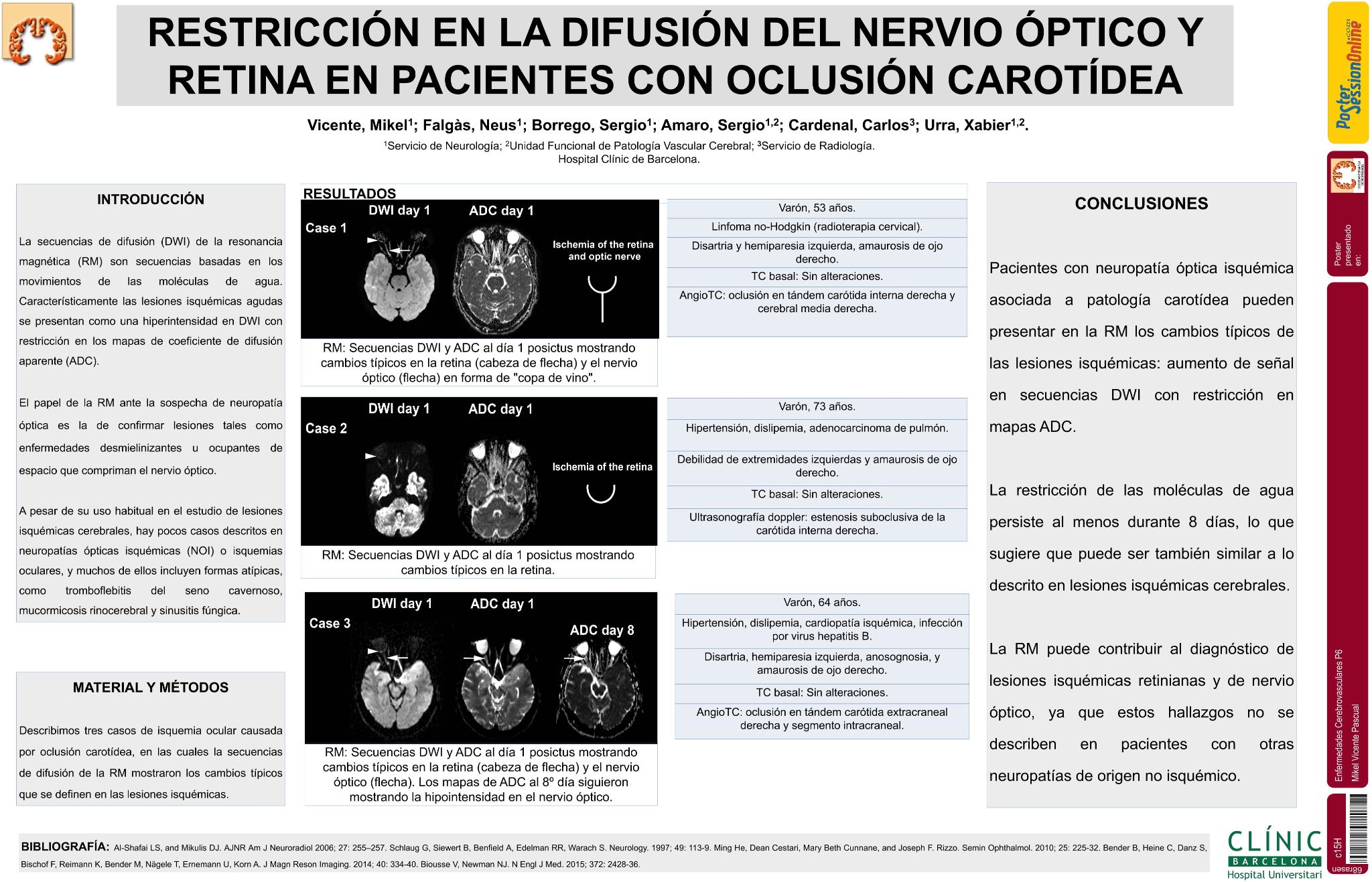 Restricción de la difusión del nervio óptico en un paciente con ictus isquémico carotídeo ipsilateral