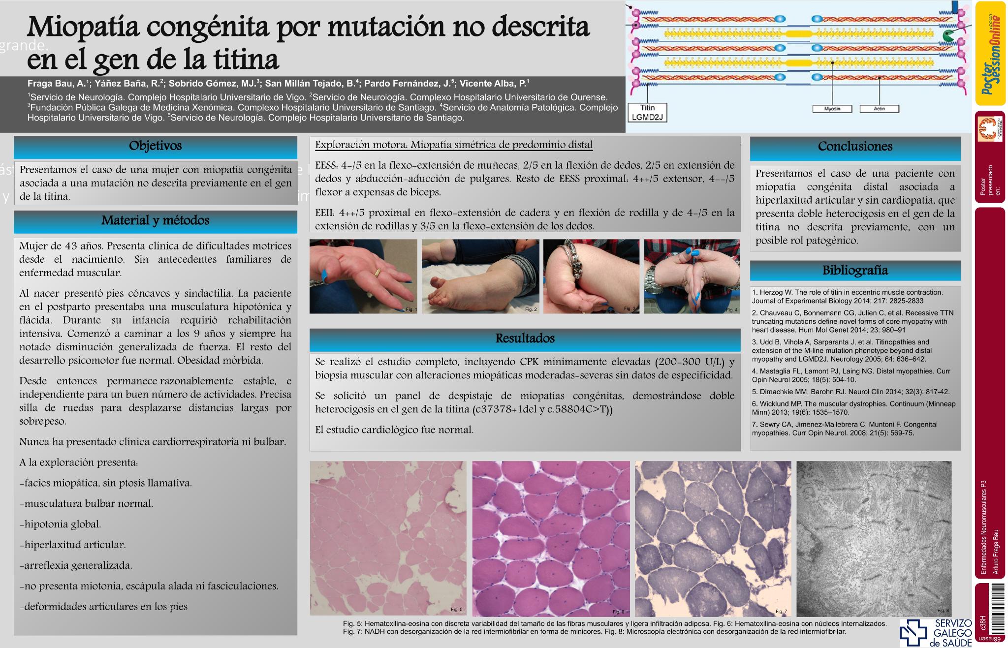 Miopatía congénita por mutación no descrita en el gen de la titina