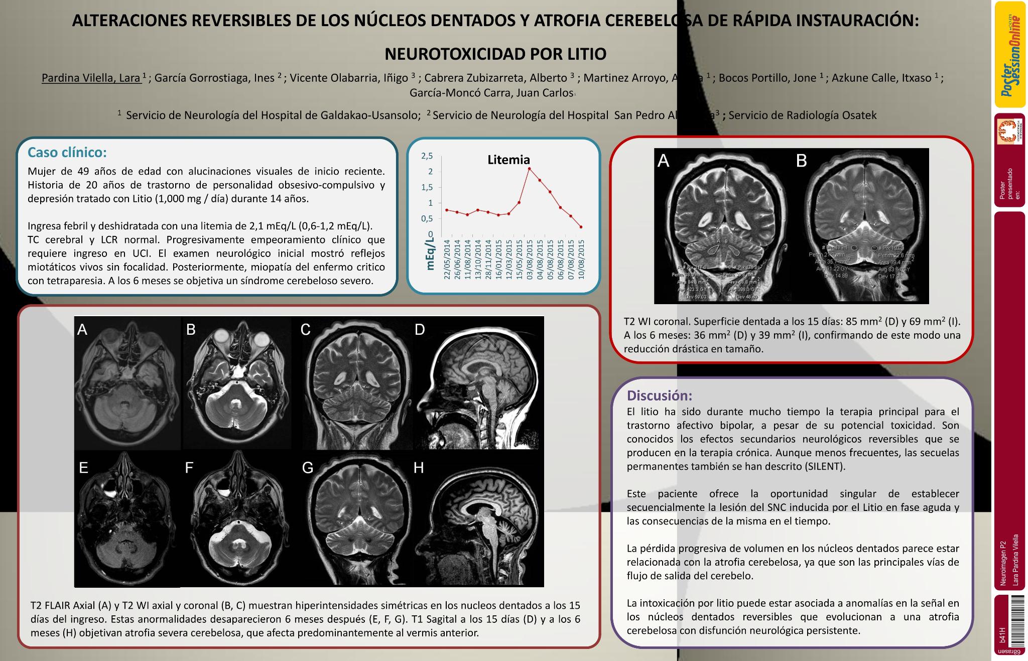 Alteraciones reversibles de los núcleos dentados y atrofia cerebelosa de rápida instauración: neurotoxicidad por litio