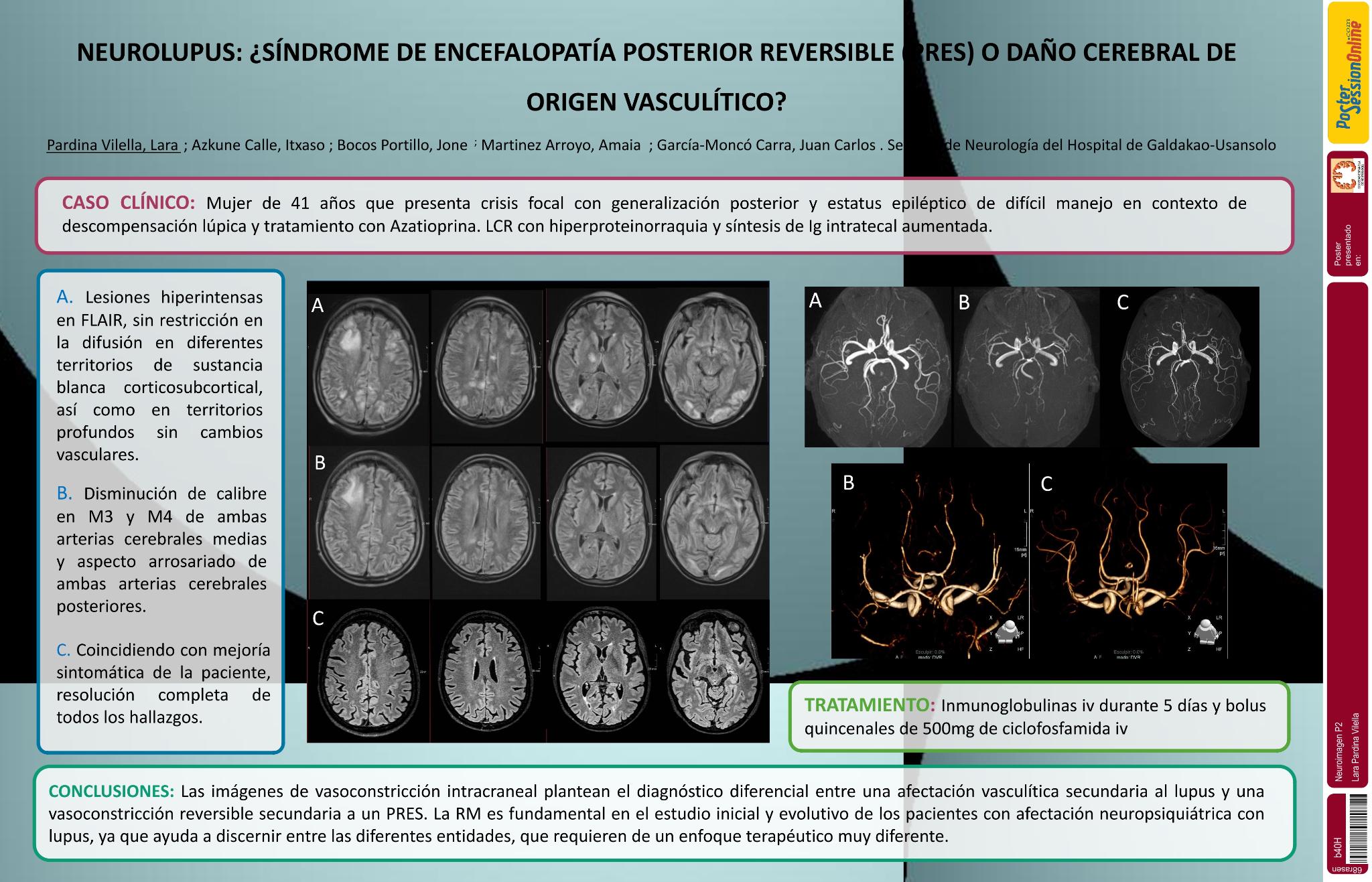 Neurolupus: ¿síndrome de encefalopatía posterior reversible (PRES) o daño cerebral de origen vasculítico?