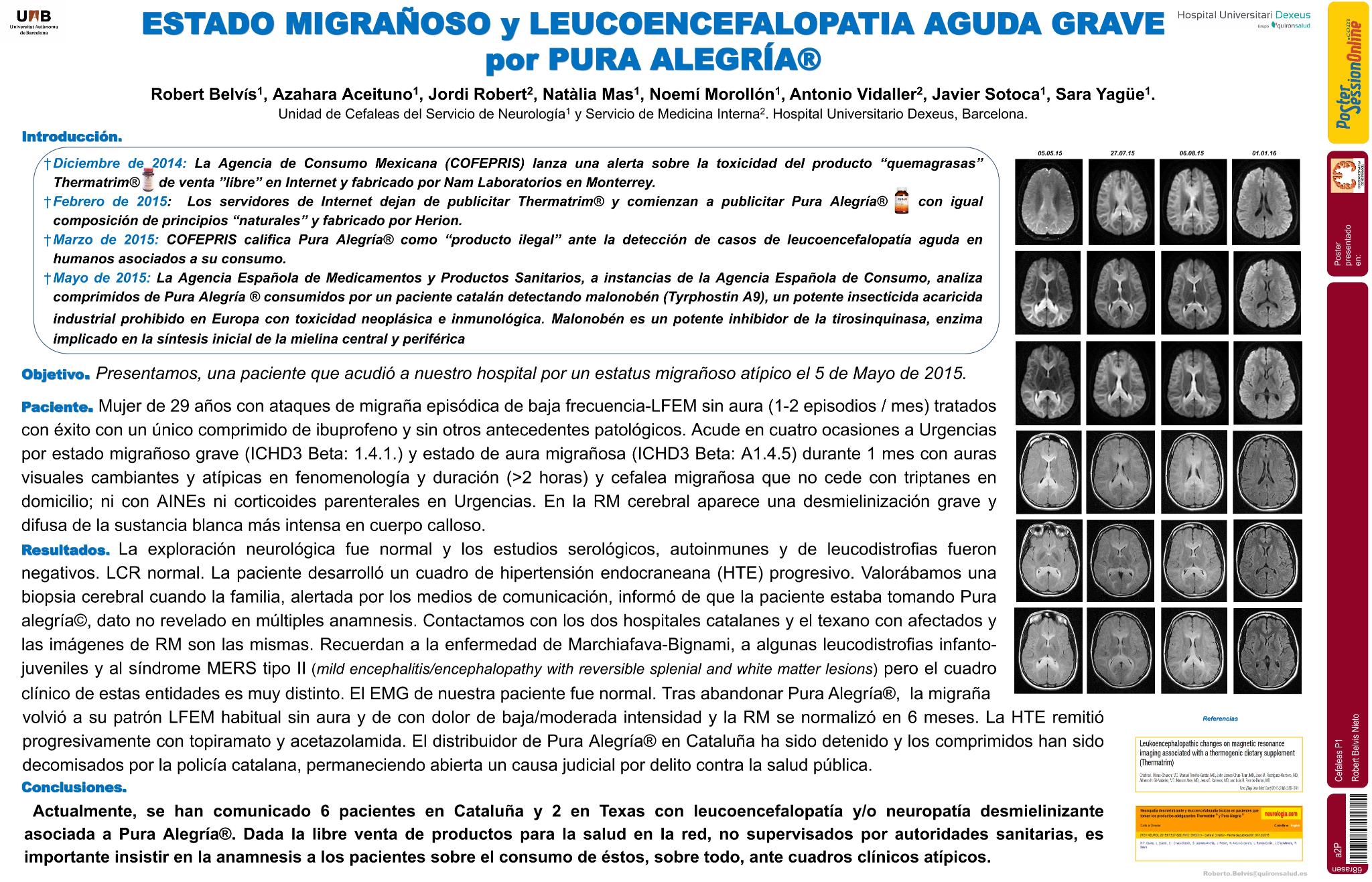 Estado migrañoso y leucoencefalopatía aguda grave por pura alegría