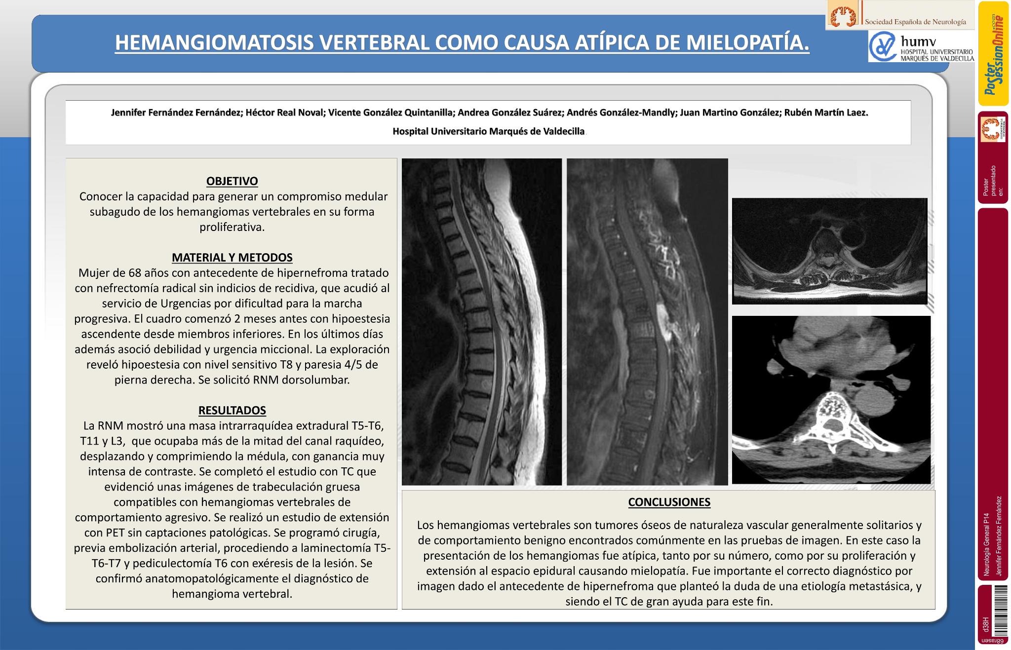 Hemangiomatosis vertebral como causa atípica de mielopatía