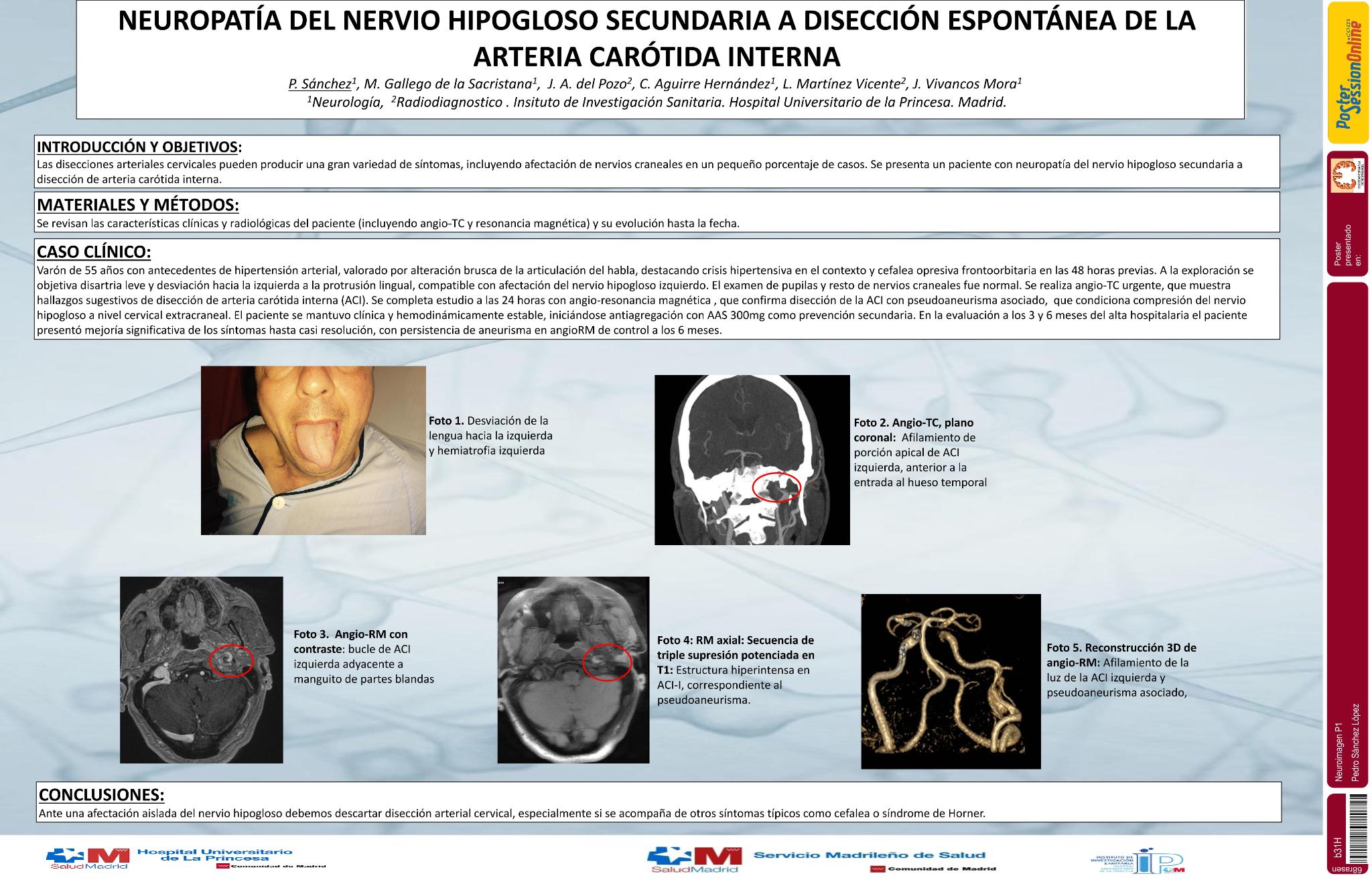 Neuropatía del nervio hipogloso secundaria a disección espontánea de la arteria carótida interna