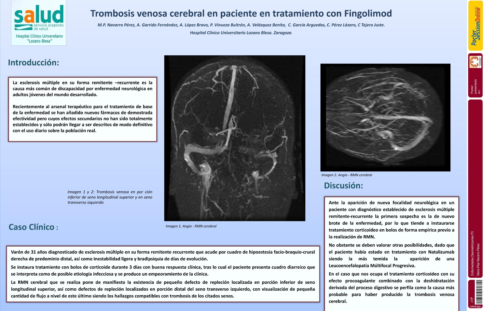 Trombosis venosa cerebral en paciente en tratamiento con Fingolimod