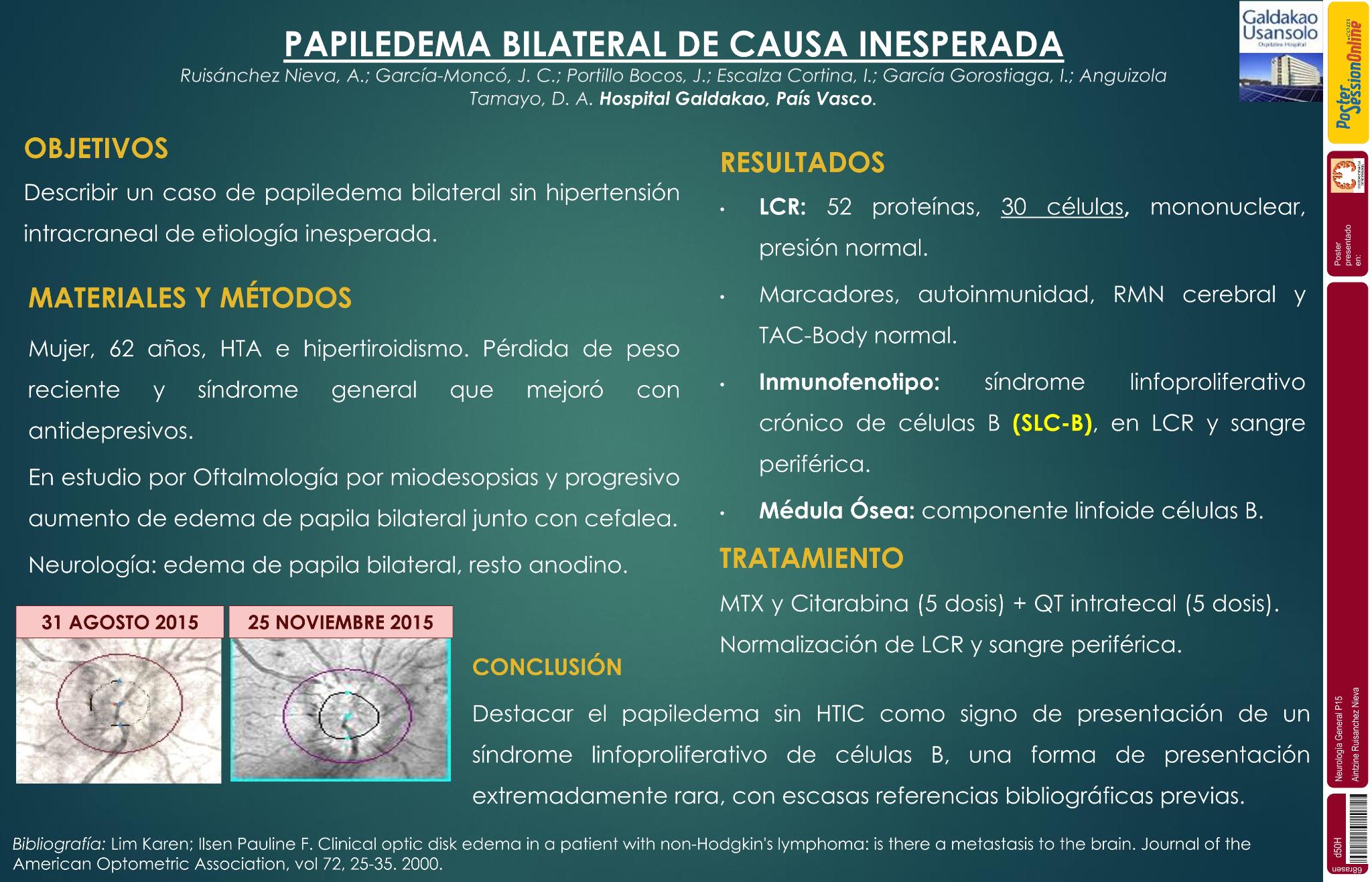 Papiledema bilateral sin HTIC de causa inesperada