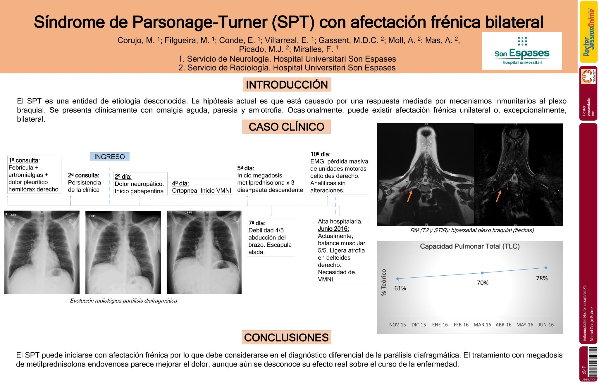 Síndrome de Parsonage-Turner (SPT) con afectación frénica bilateral