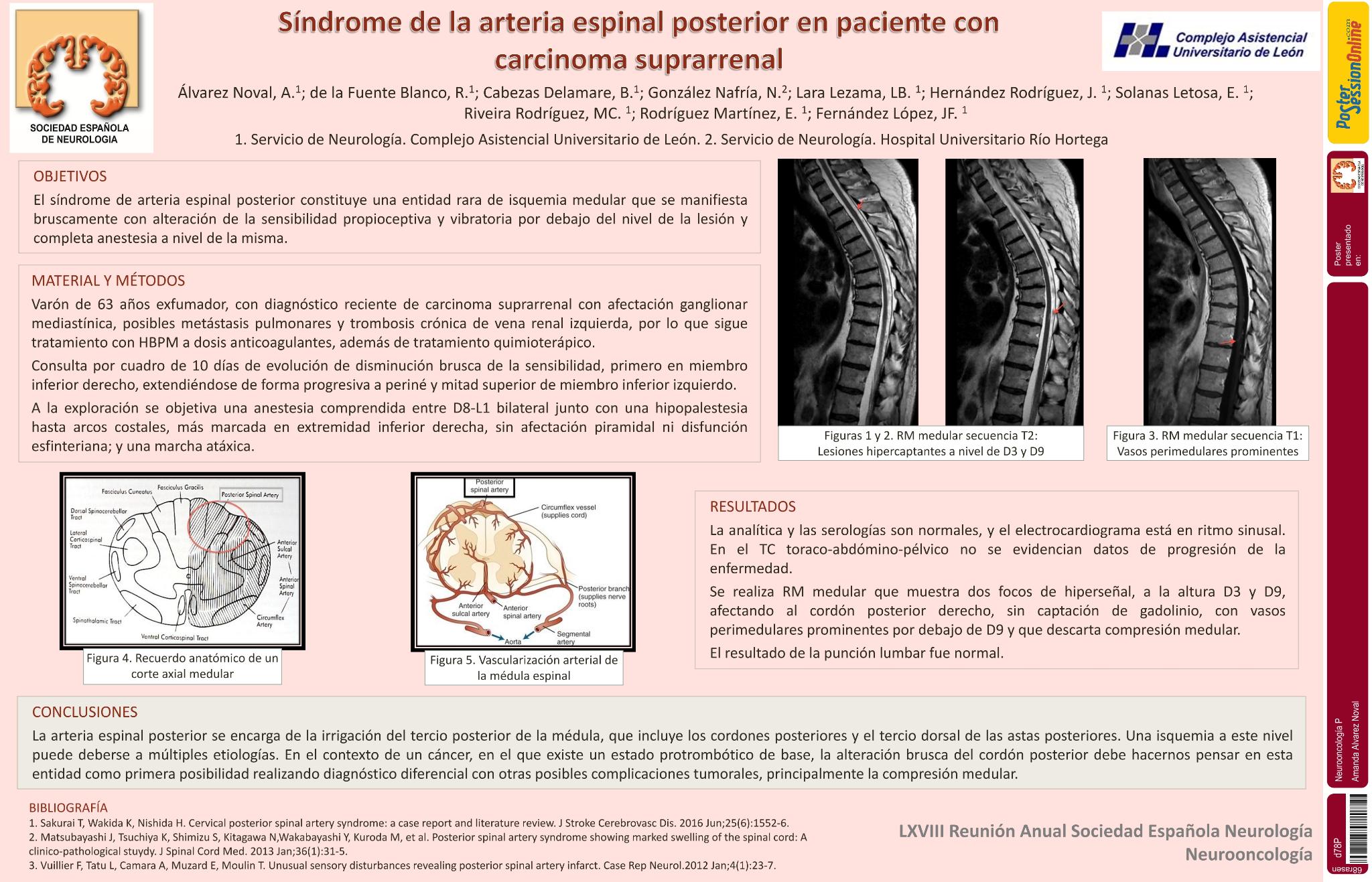 Síndrome de la arteria espinal posterior en paciente con carcinoma suprarrenal