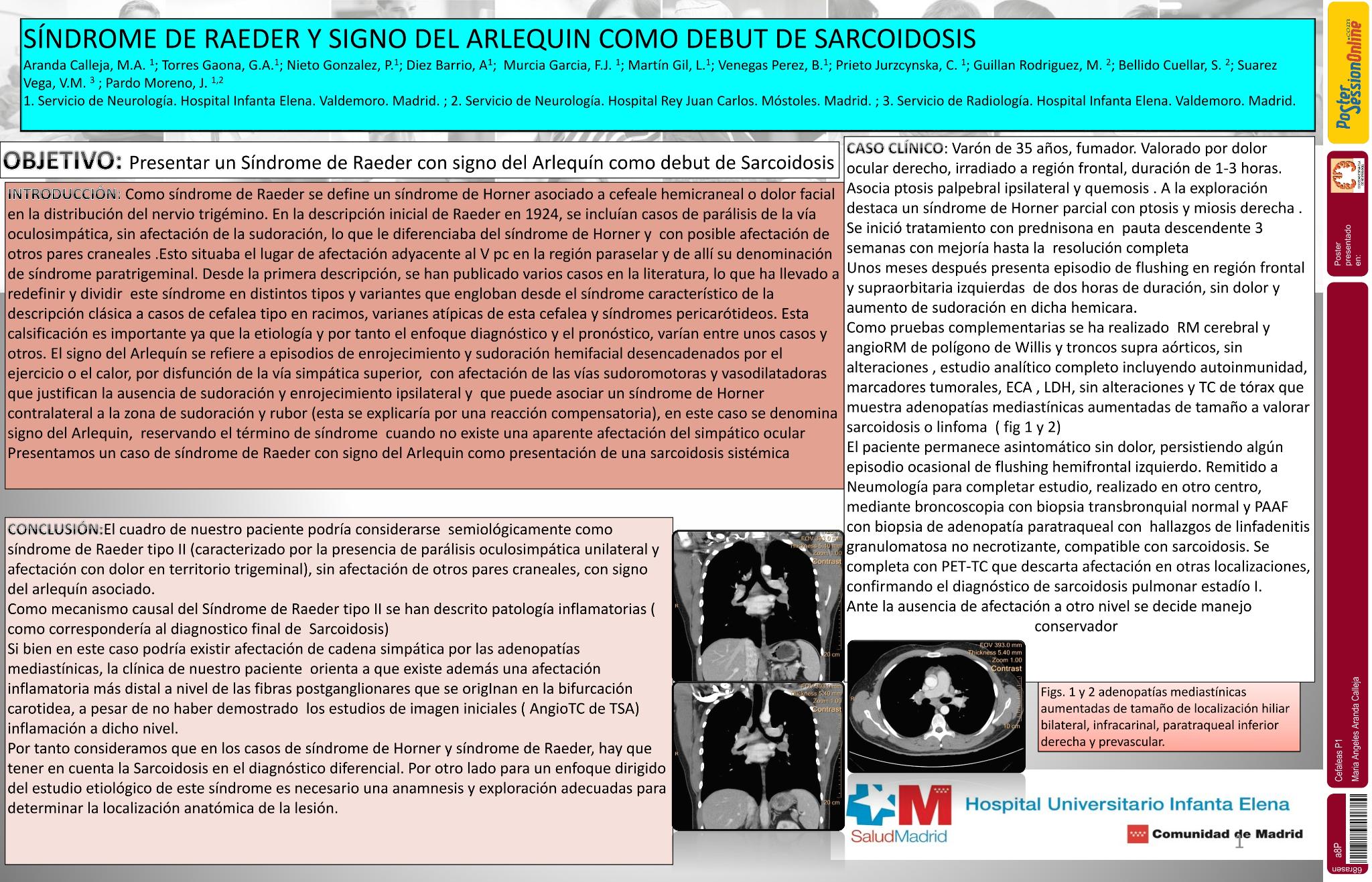 Síndrome de Raeder y signo del Arlequin como debut de Sarcoidosis